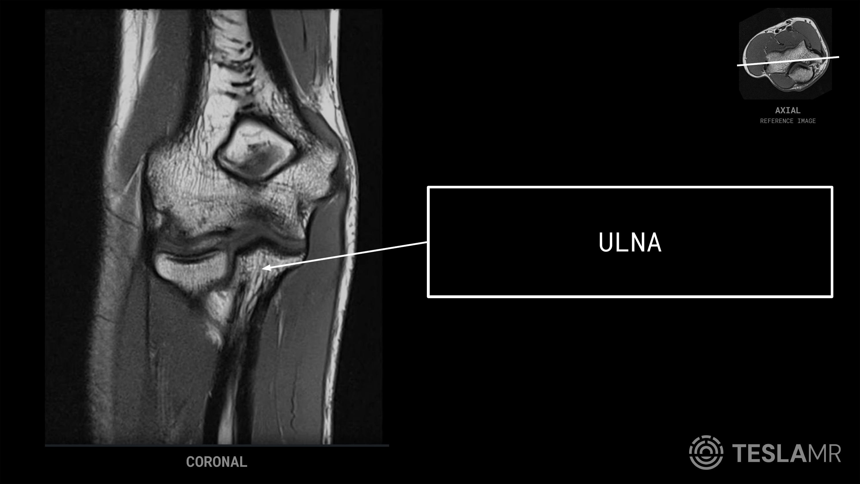 Ulna labeled on a Elbow MRI (Coronal)