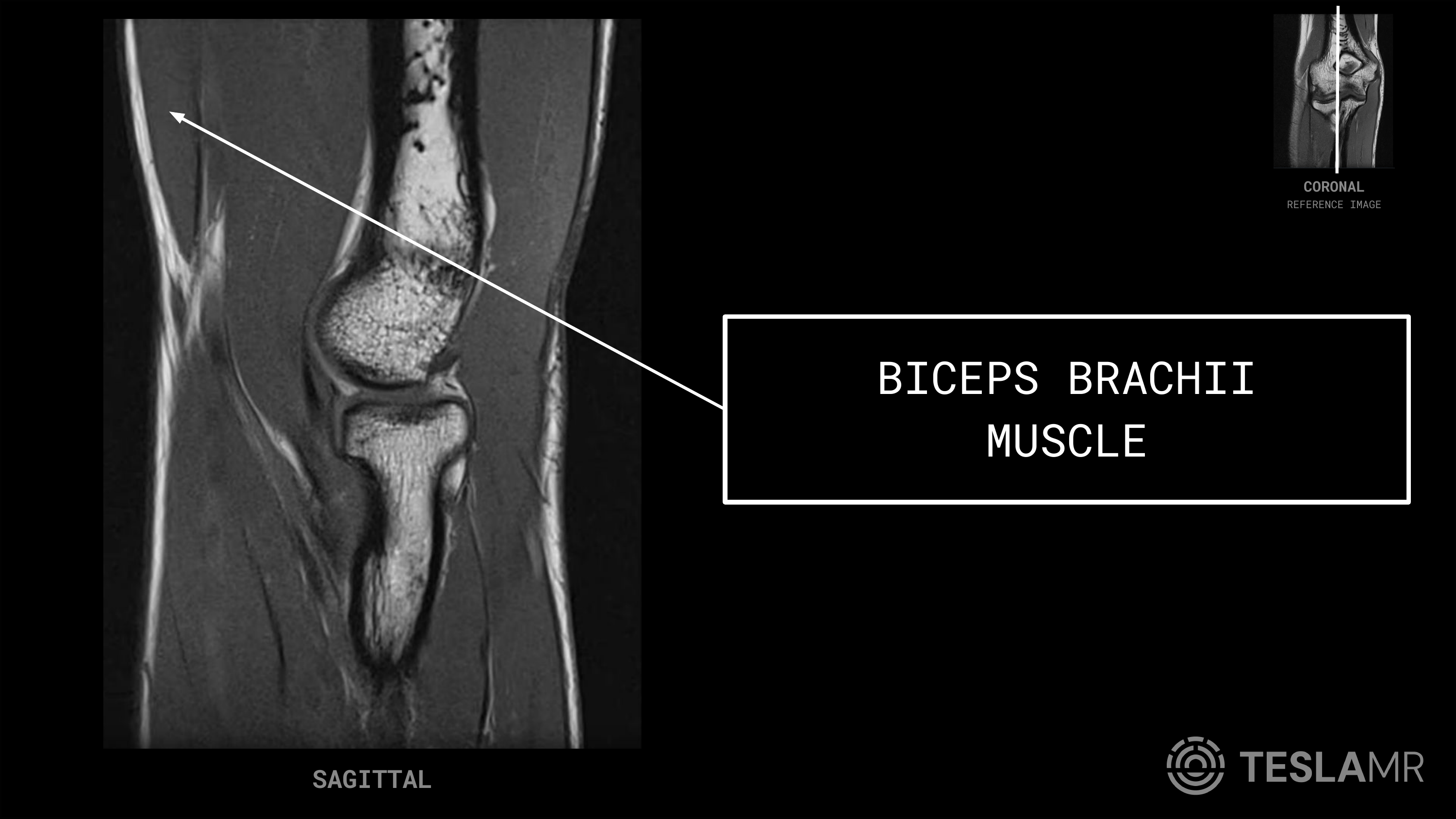 Biceps Brachii Muscle labeled on a Elbow MRI (Sagittal)