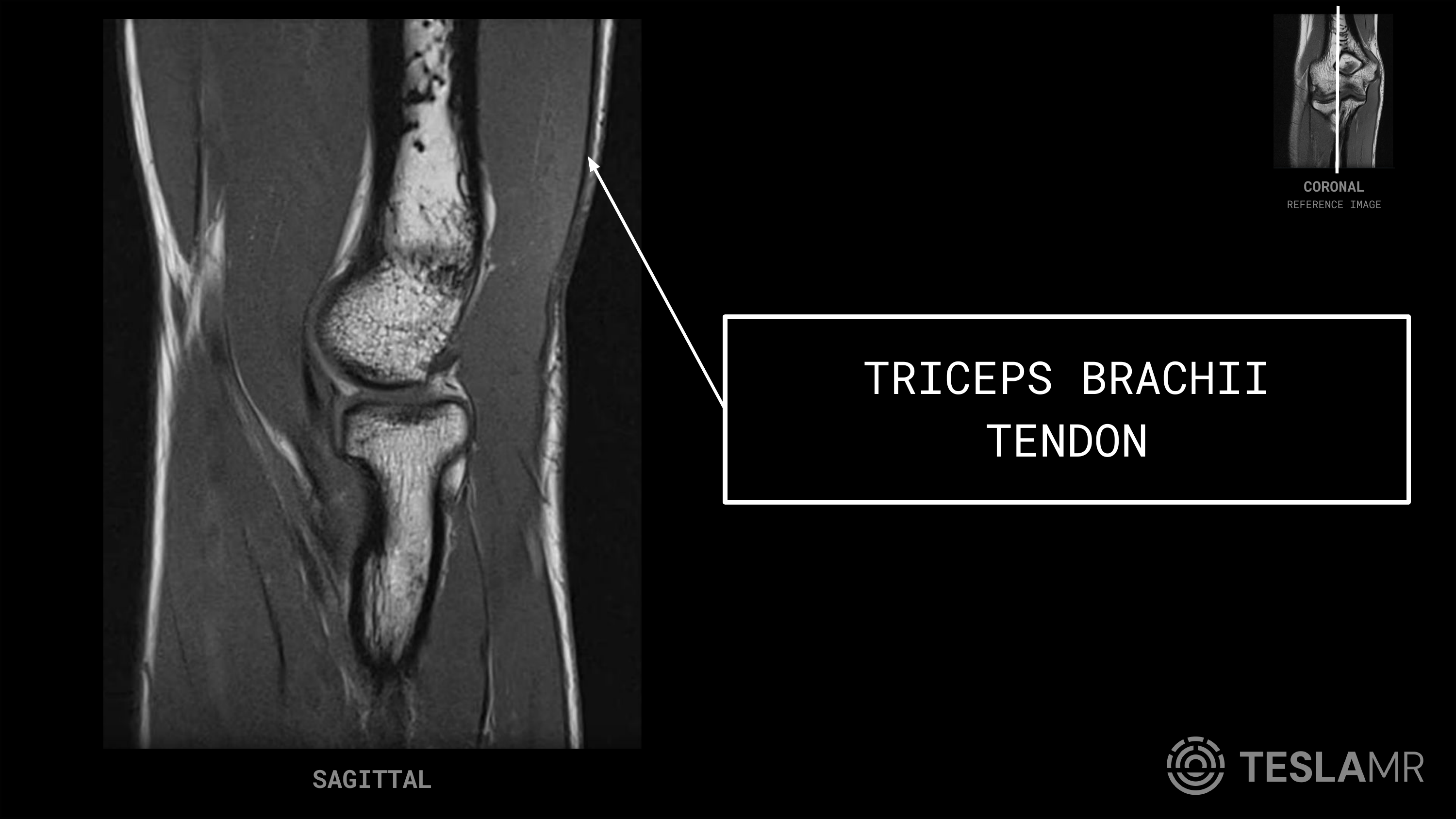 Triceps Brachii Tendon labeled on a Elbow MRI (Sagittal)