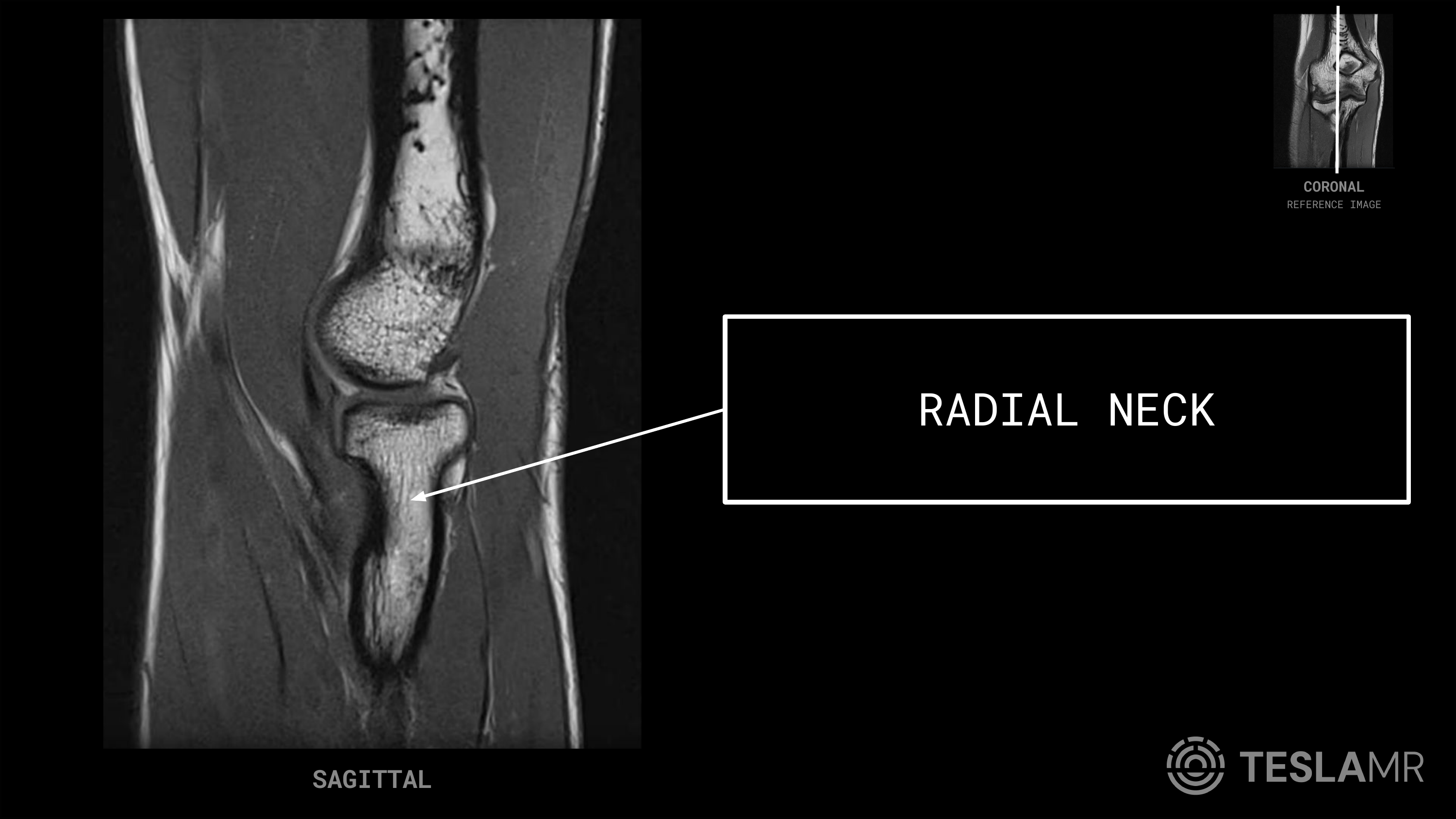 Radial Neck labeled on a Elbow MRI (Sagittal)