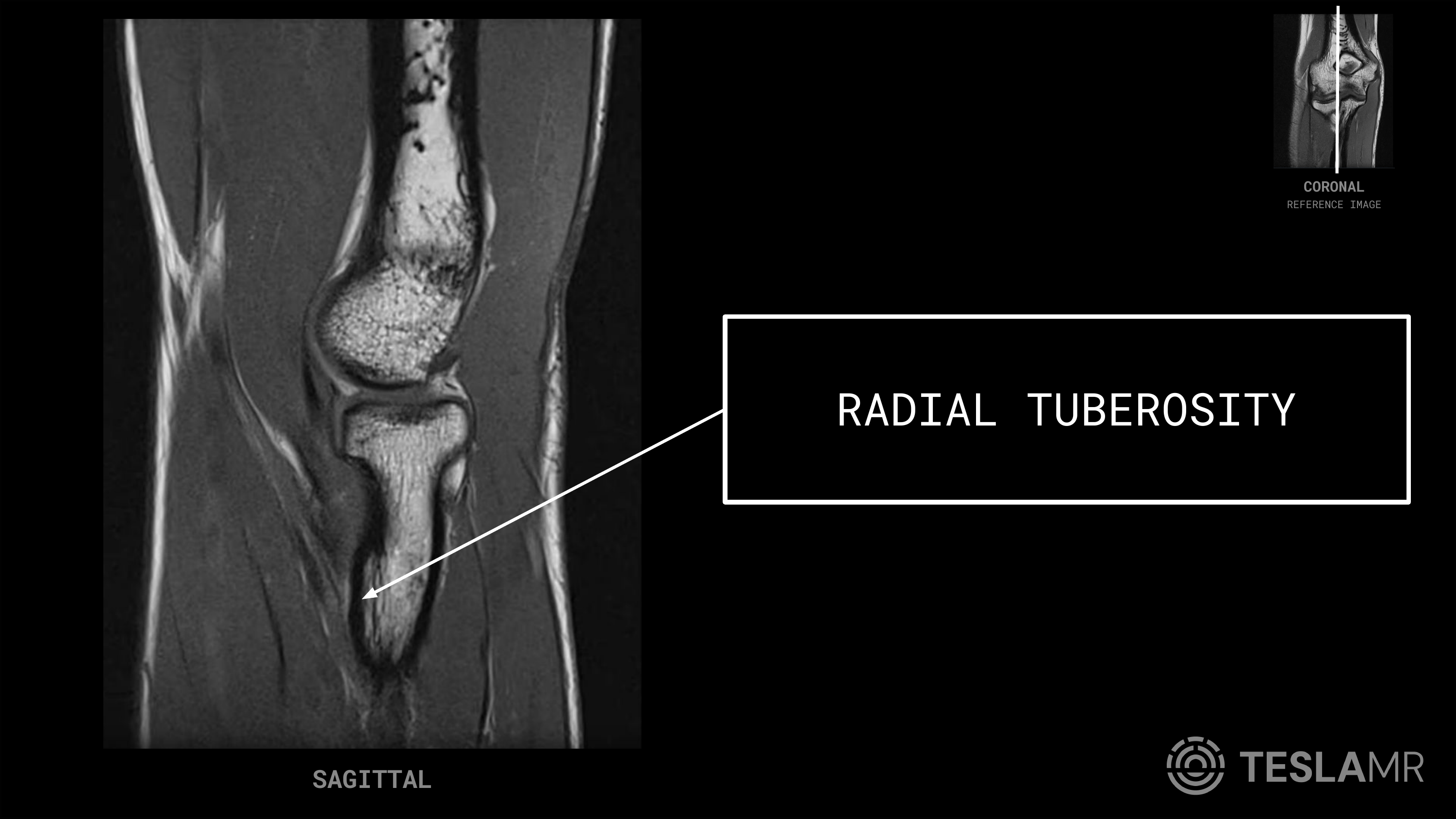Radial Tuberosity labeled on a Elbow MRI (Sagittal)