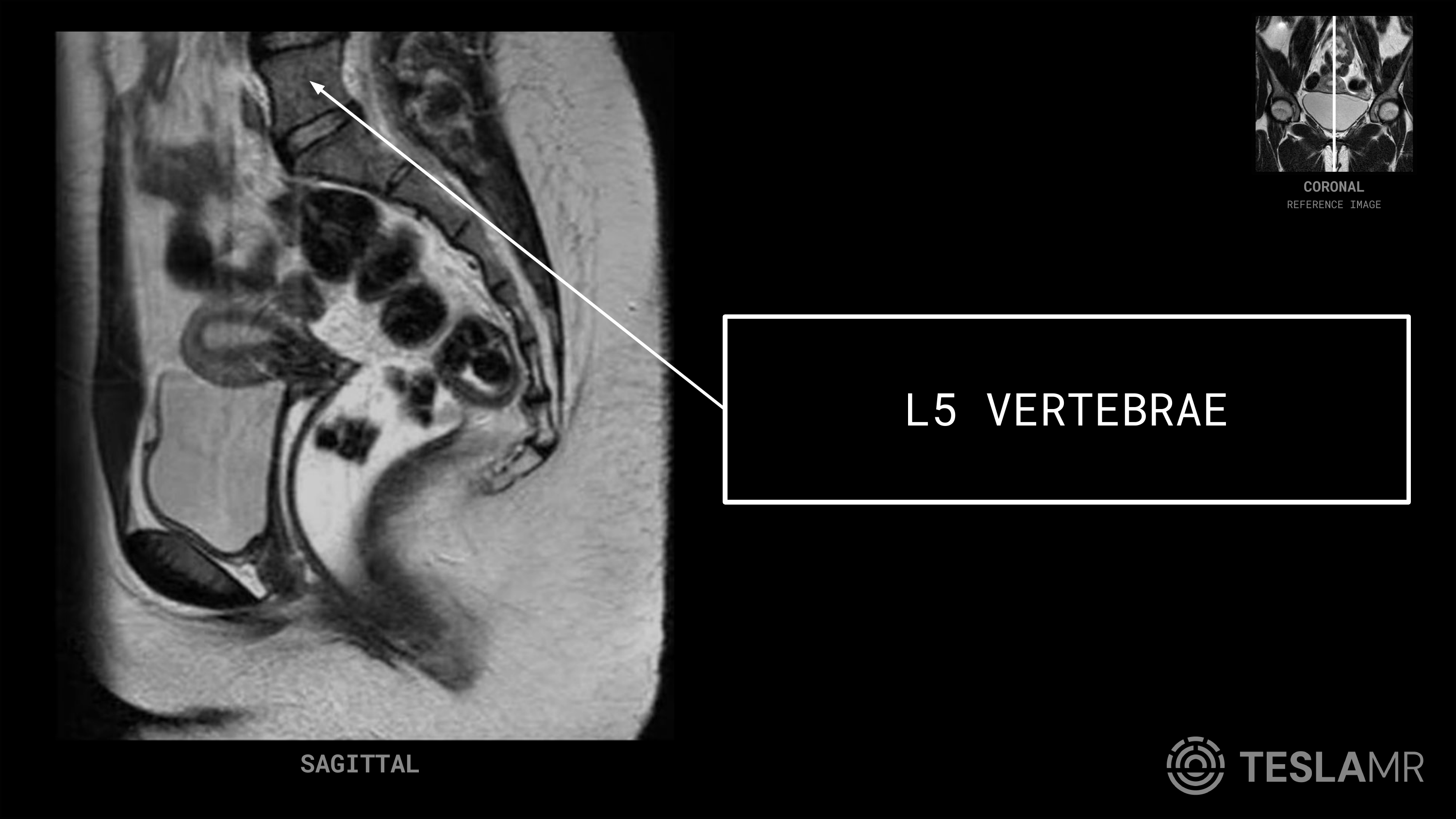 L5 Vertebrae labeled on a Female Pelvis MRI (Sagittal)