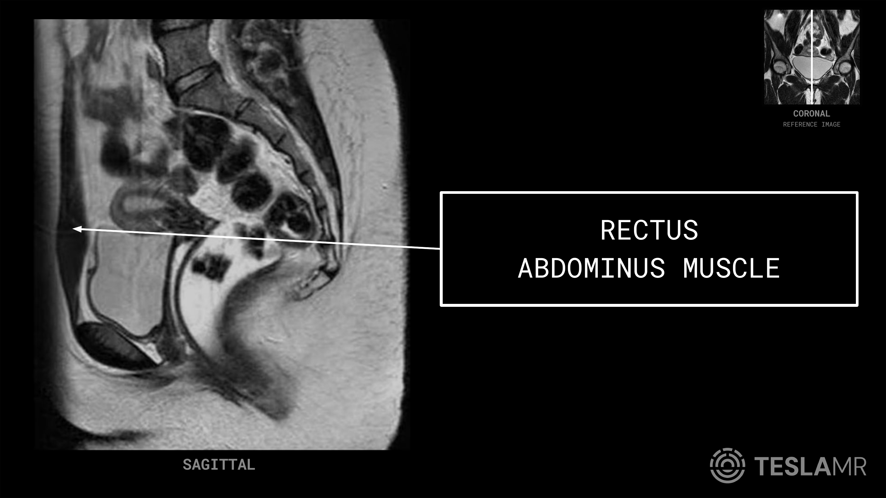 Rectus Abdominus Muscle labeled on a Female Pelvis MRI (Sagittal)
