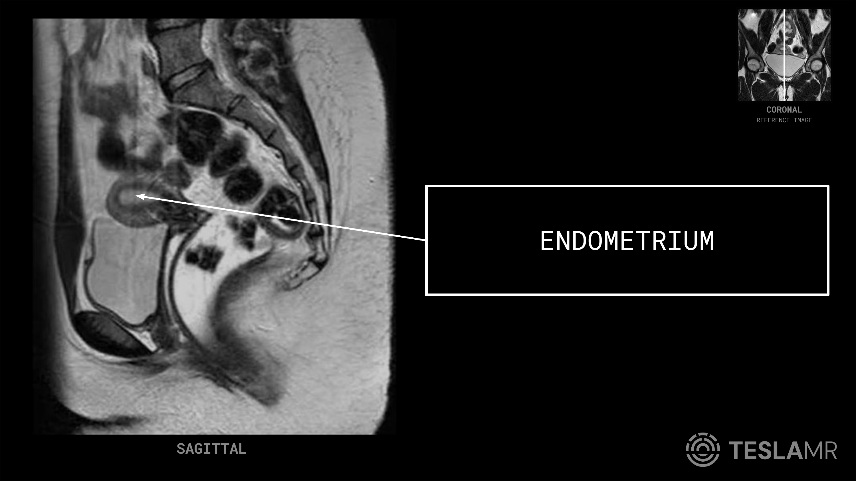 Endometrium labeled on a Female Pelvis MRI (Sagittal · Coronal)
