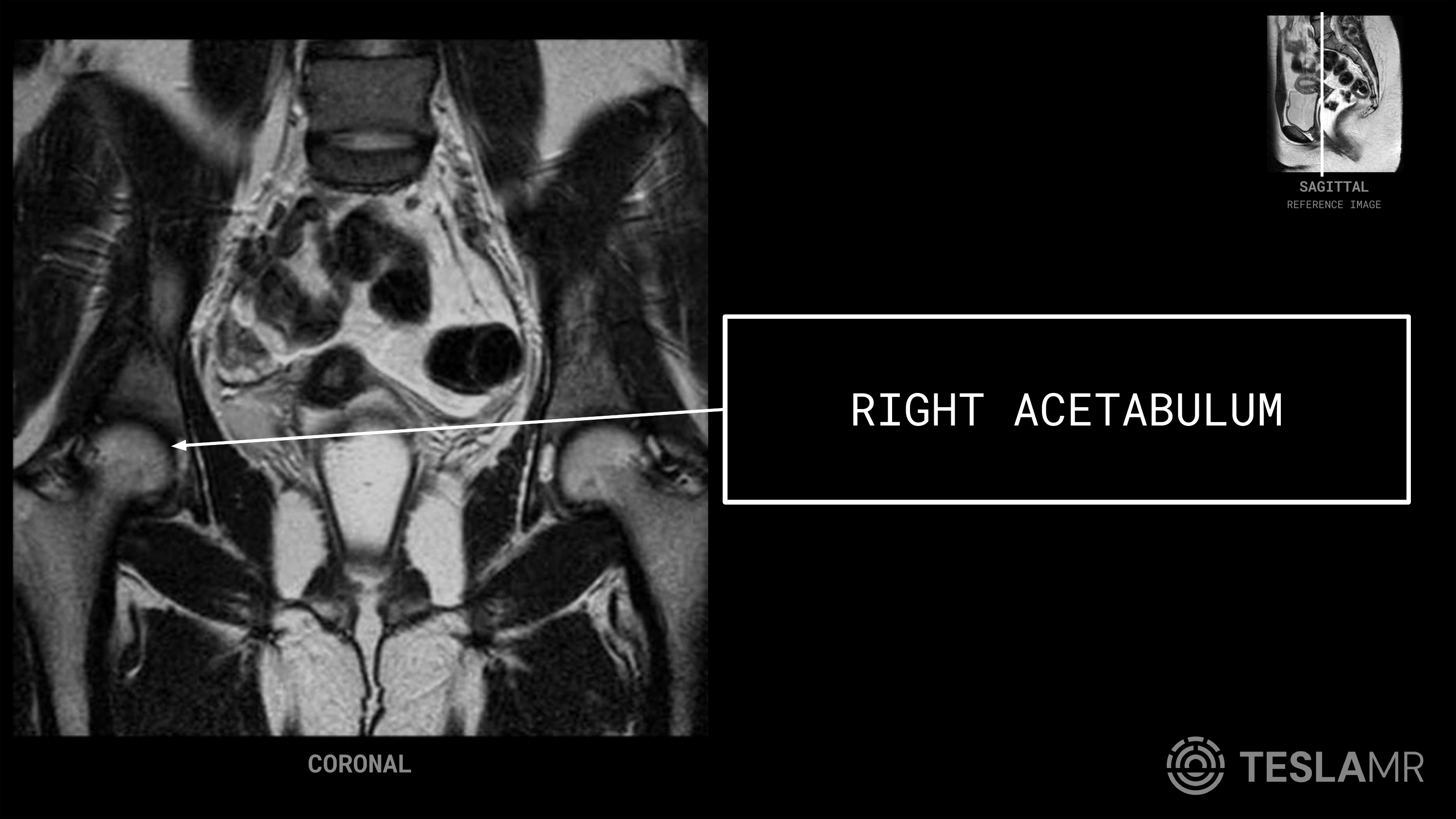 Right Acetabulum labeled on a Female Pelvis MRI (Coronal)