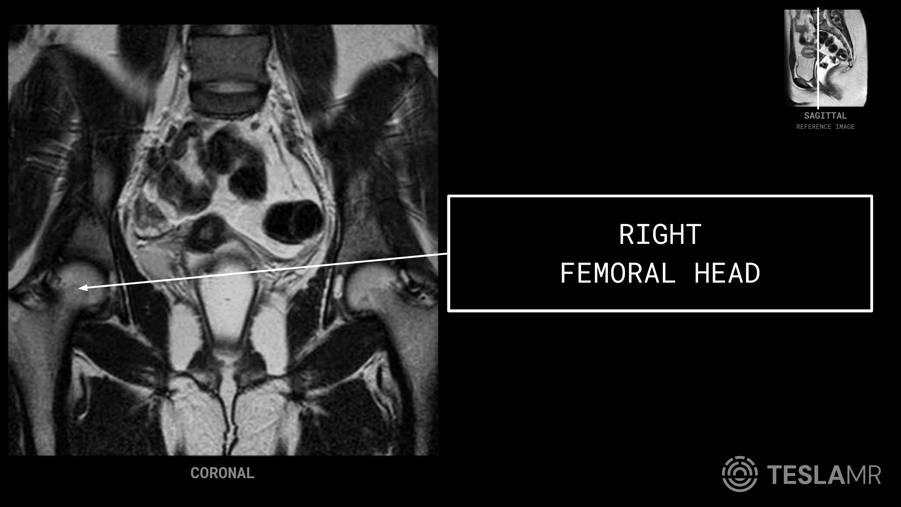 Right Femoral Head labeled on a Female Pelvis MRI (Coronal)