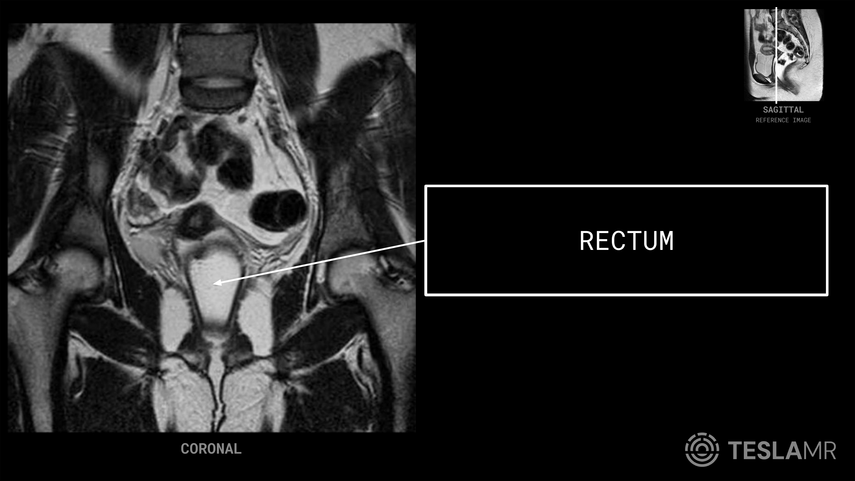 Rectum labeled on a Female Pelvis MRI (Coronal · Axial)