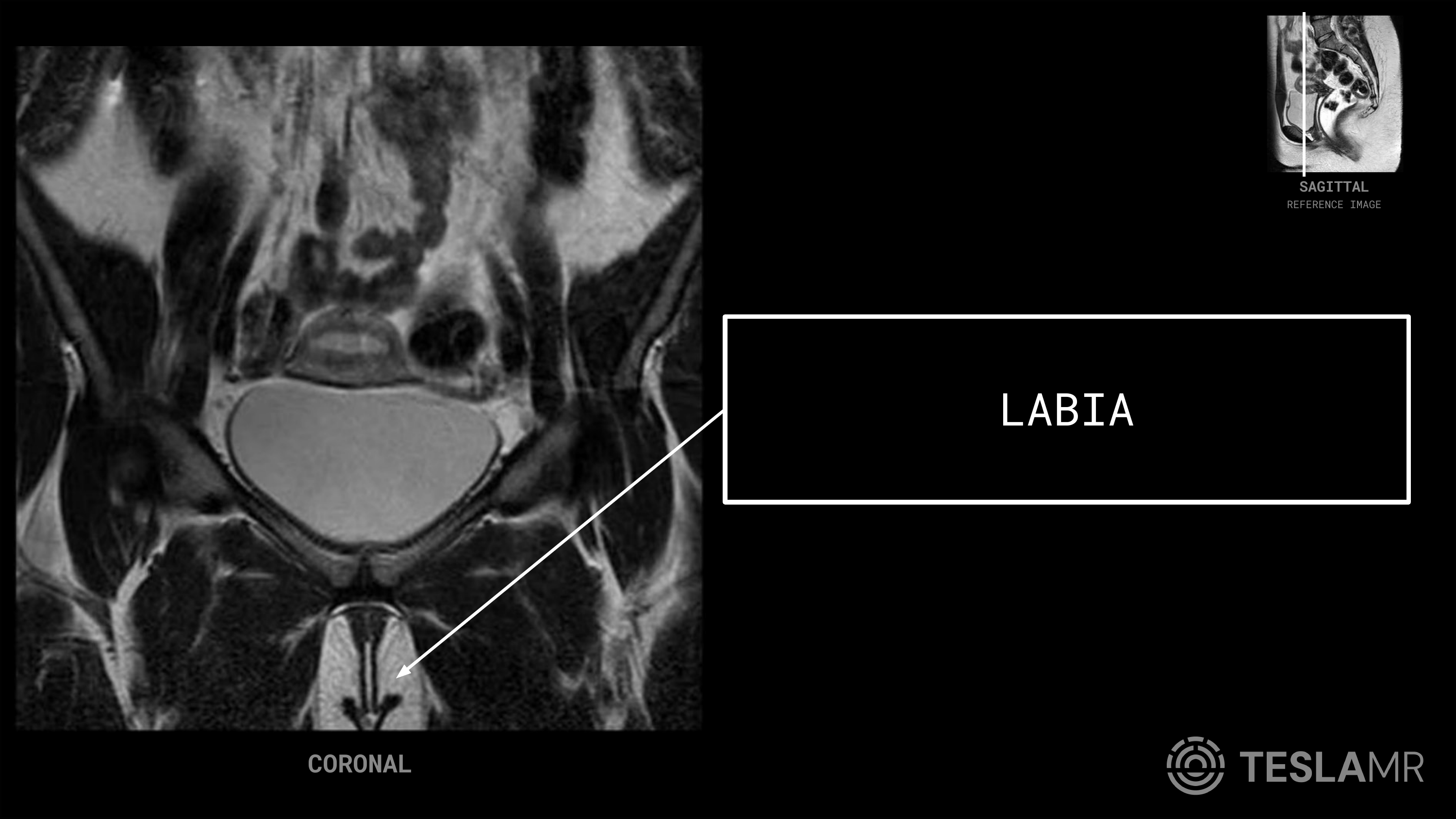 Labia labeled on a Female Pelvis MRI (Coronal)