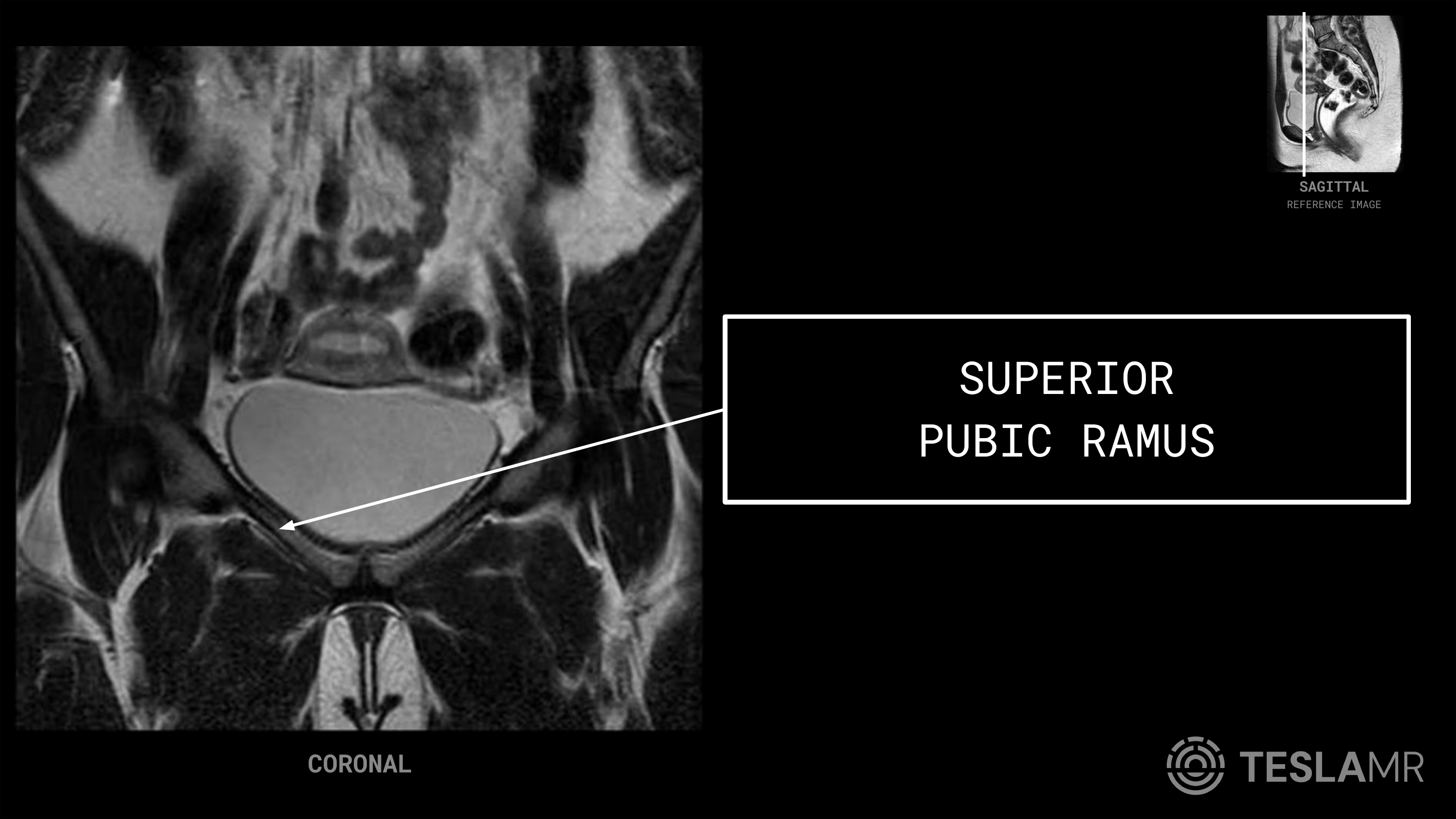 Superior Pubic Ramus labeled on a Female Pelvis MRI (Coronal)