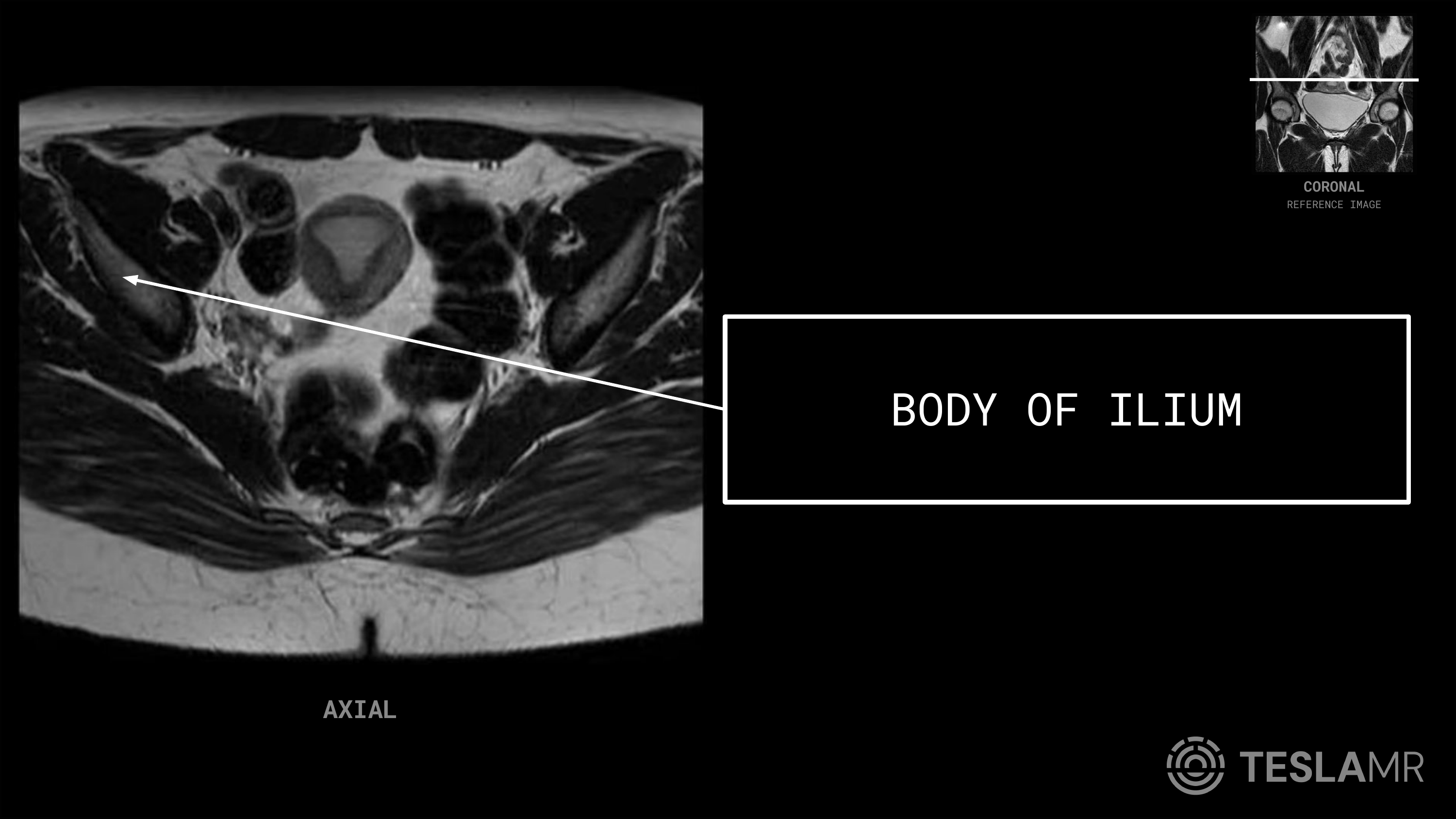 Body of Ilium labeled on a Female Pelvis MRI (Axial)