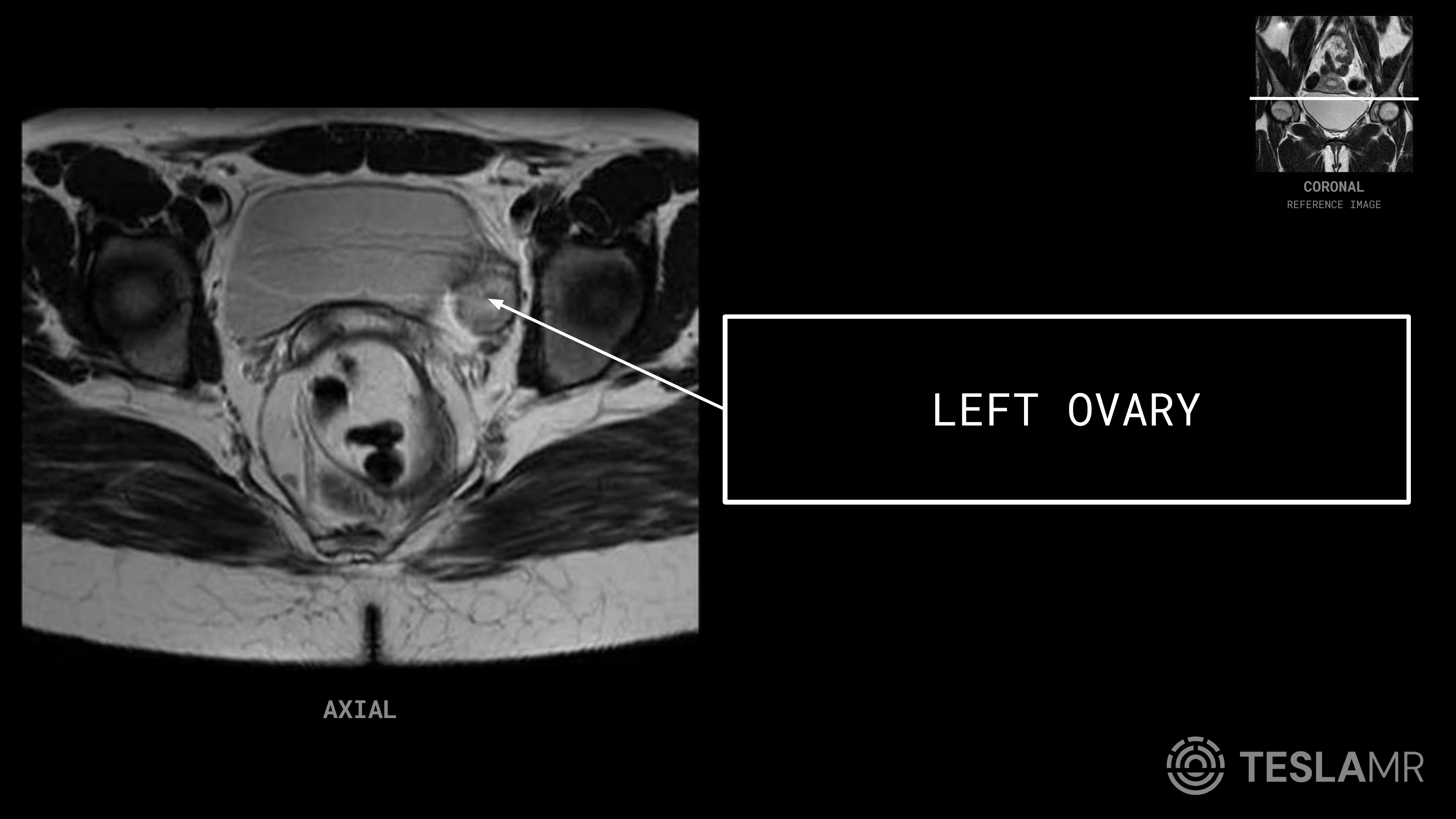 Left Ovary labeled on a Female Pelvis MRI (Axial)