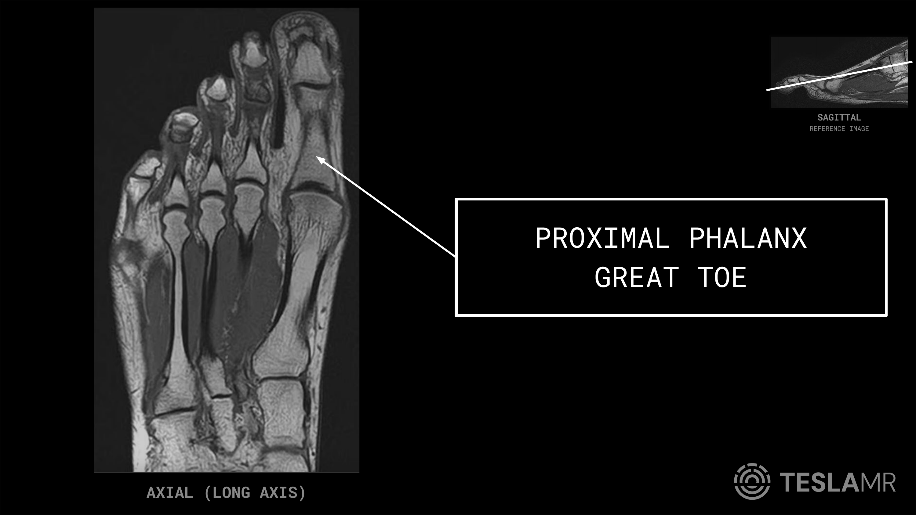Proximal Phalanx Great Toe labeled on a Foot MRI (Axial)