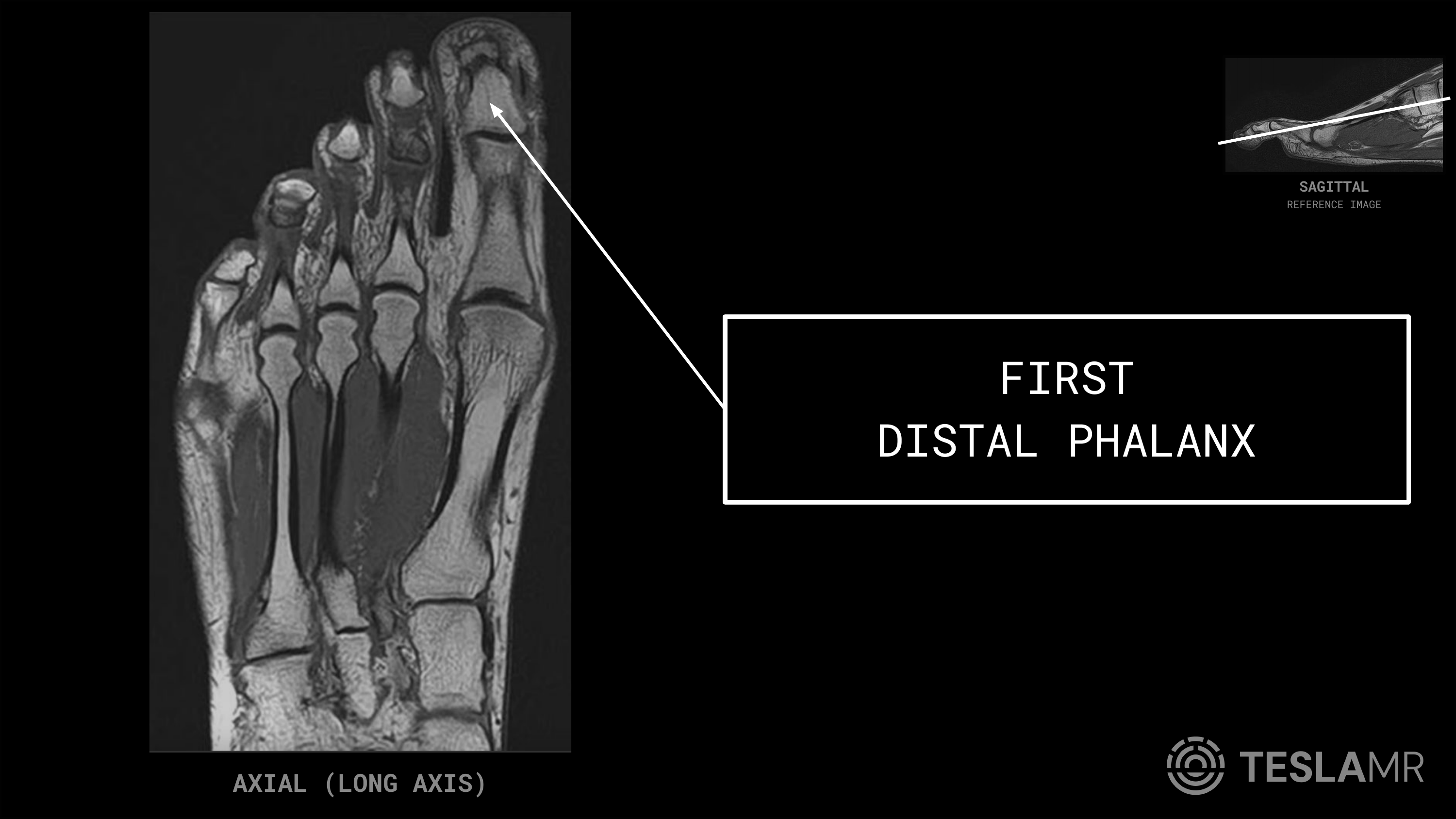 First Distal Phalanx labeled on a Foot MRI (Axial)