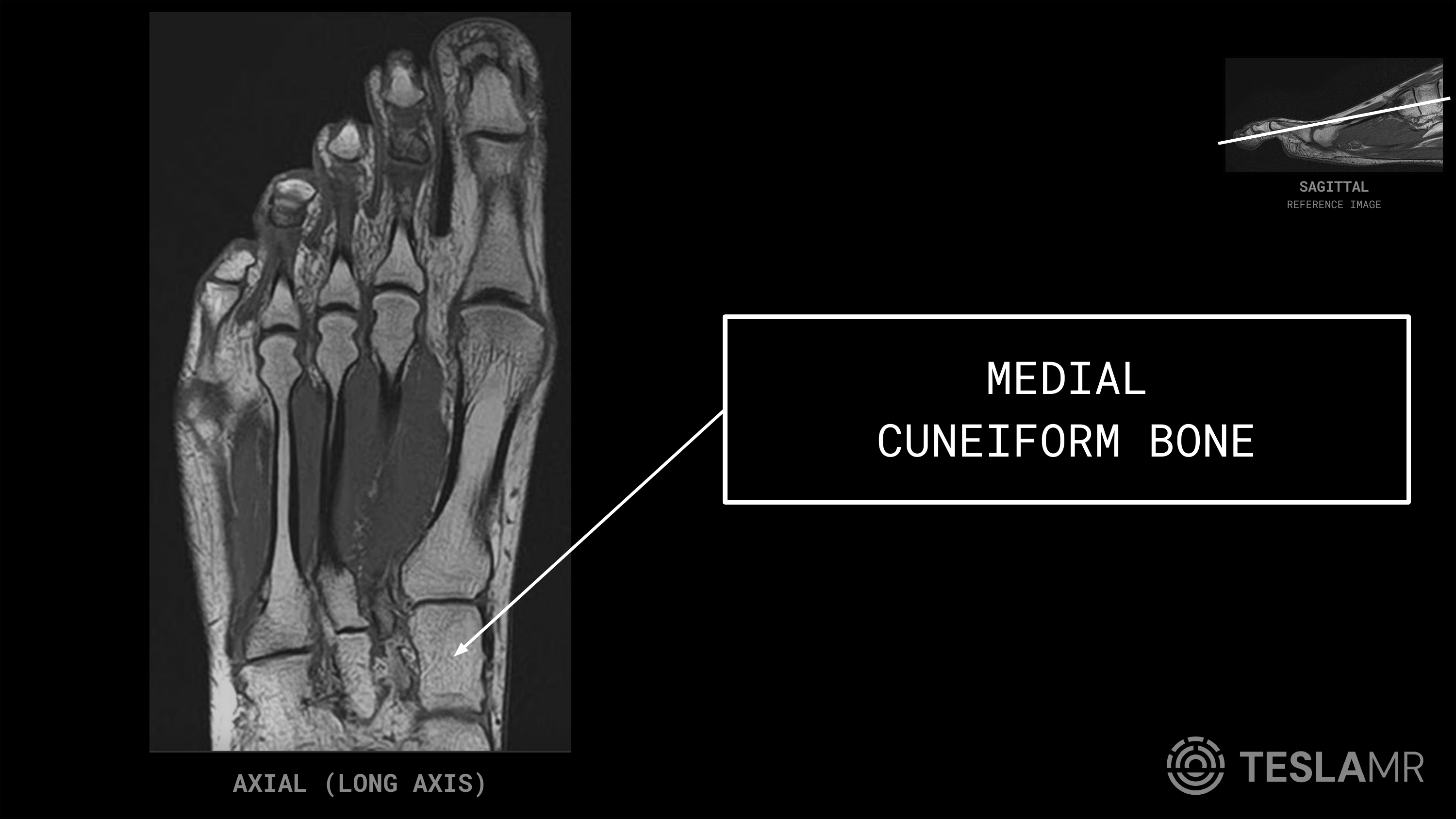 Medial Cuneiform Bone labeled on a Foot MRI (Axial)