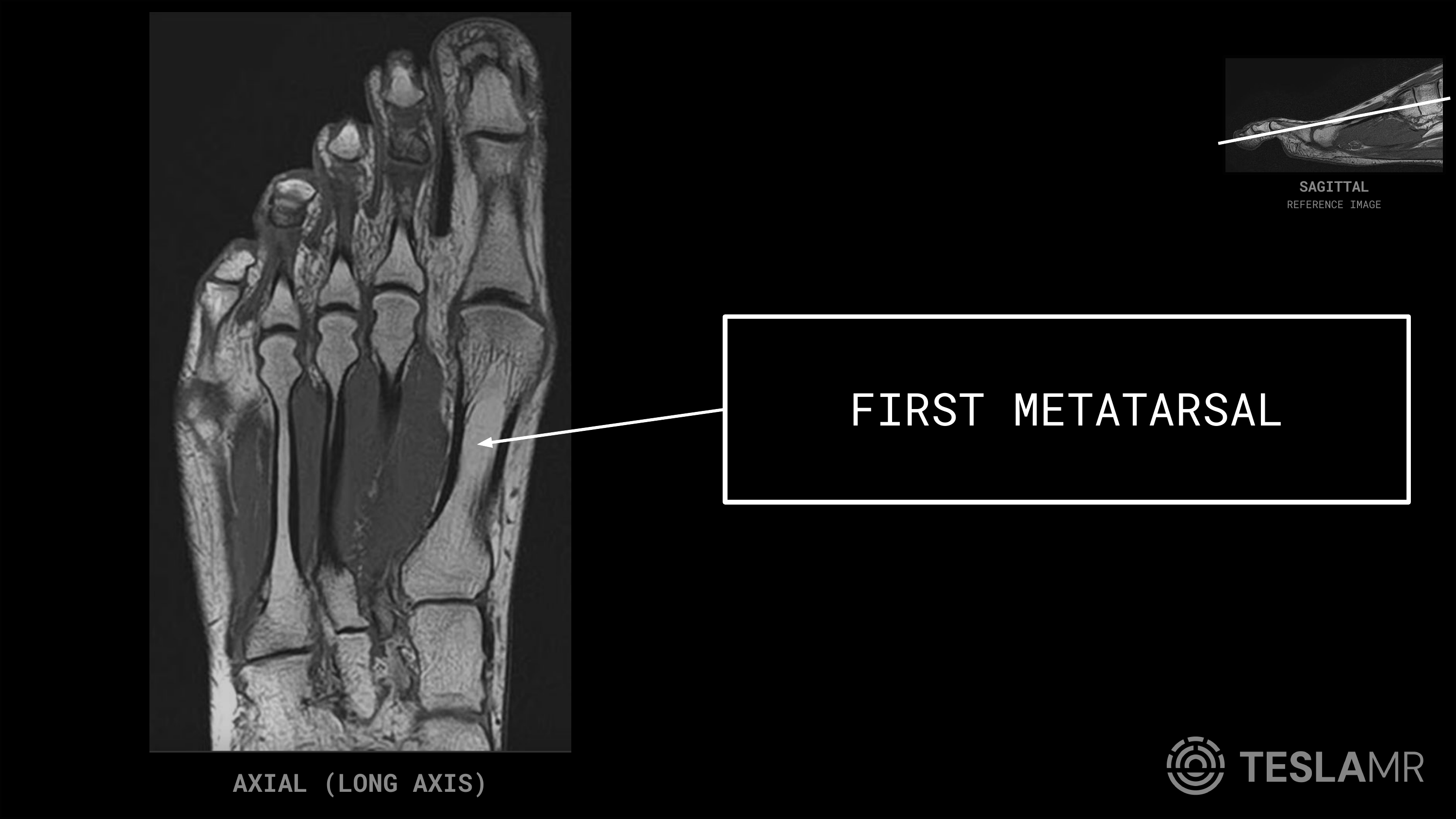 First Metatarsal labeled on a Foot MRI (Axial · Coronal)