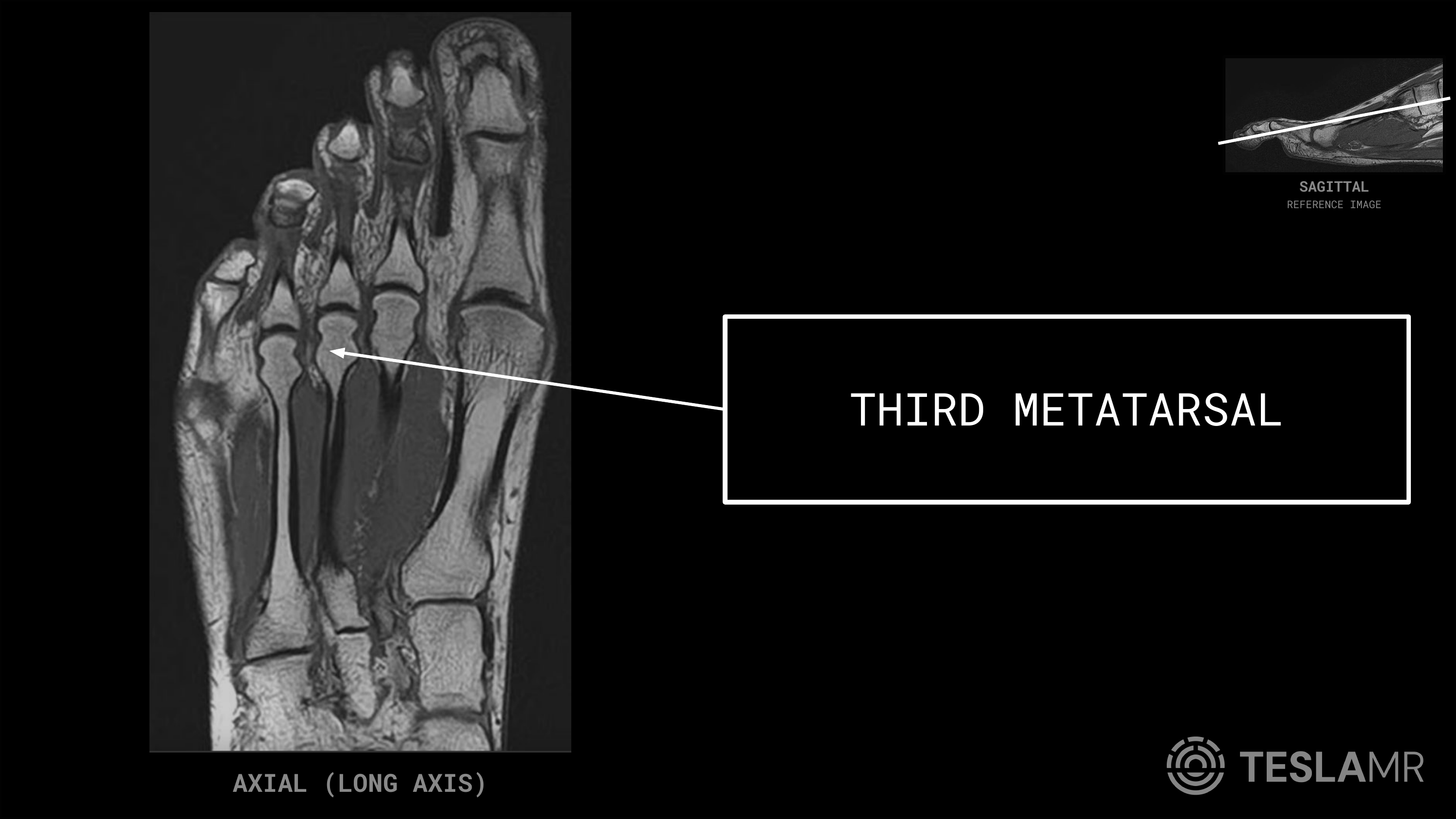 Third Metatarsal labeled on a Foot MRI (Axial · Coronal)