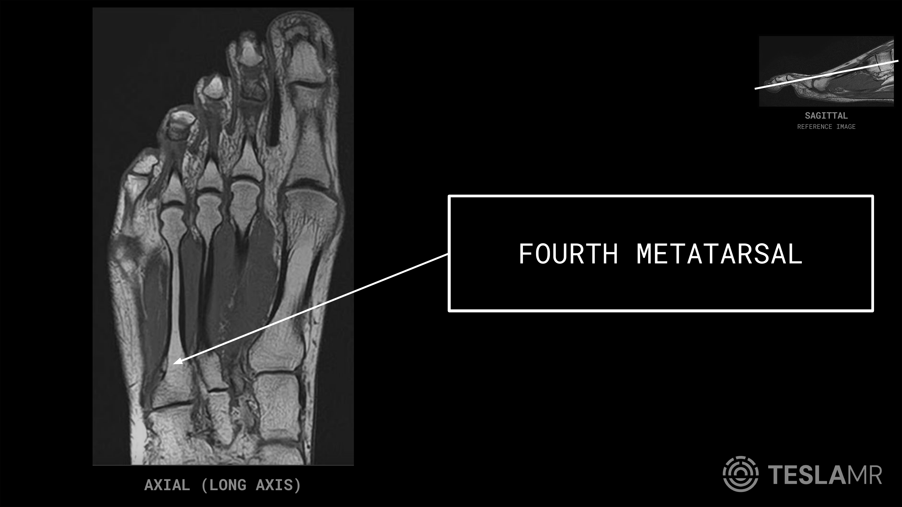 Fourth Metatarsal labeled on a Foot MRI (Axial · Coronal)