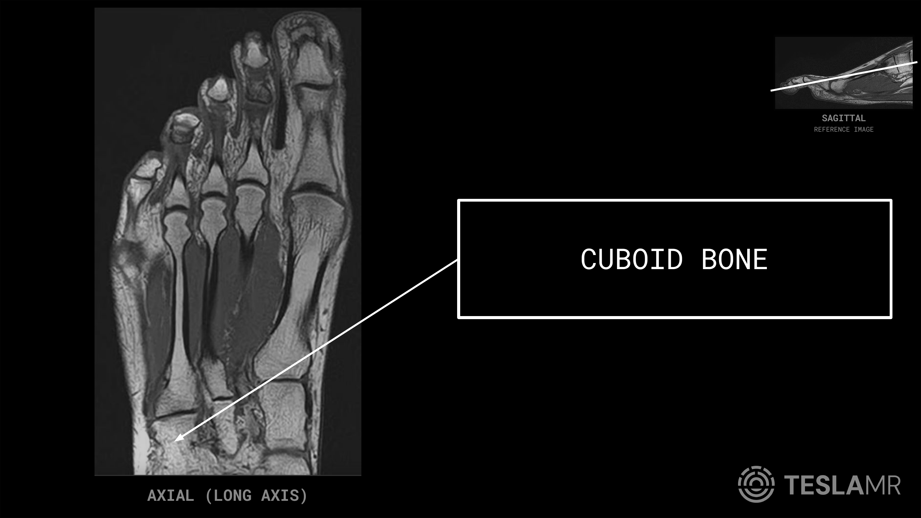 Cuboid Bone labeled on a Foot MRI (Axial)