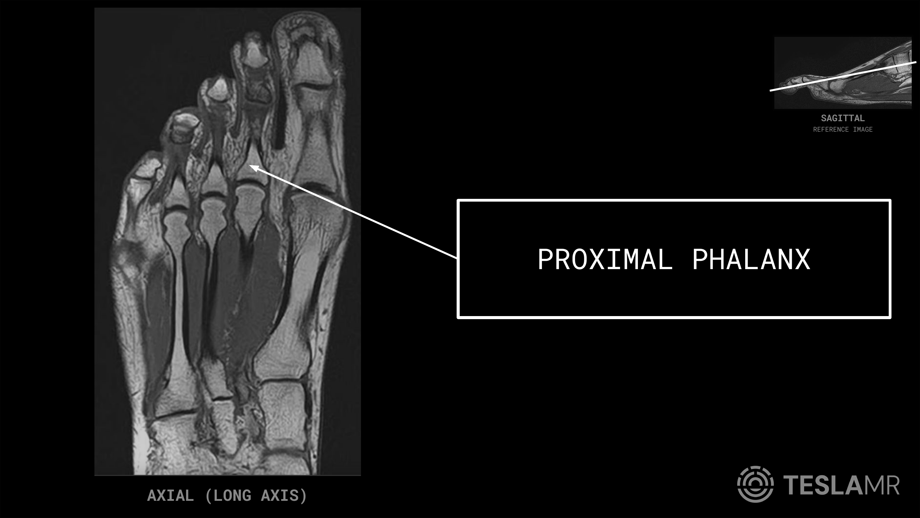 Proximal Phalanx labeled on a Foot MRI (Axial)