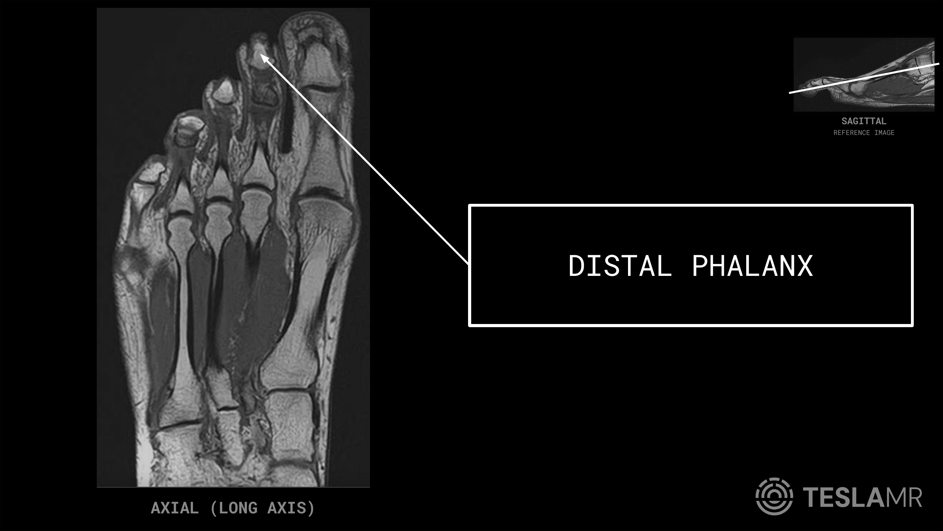 Distal Phalanx labeled on a Foot MRI (Axial)