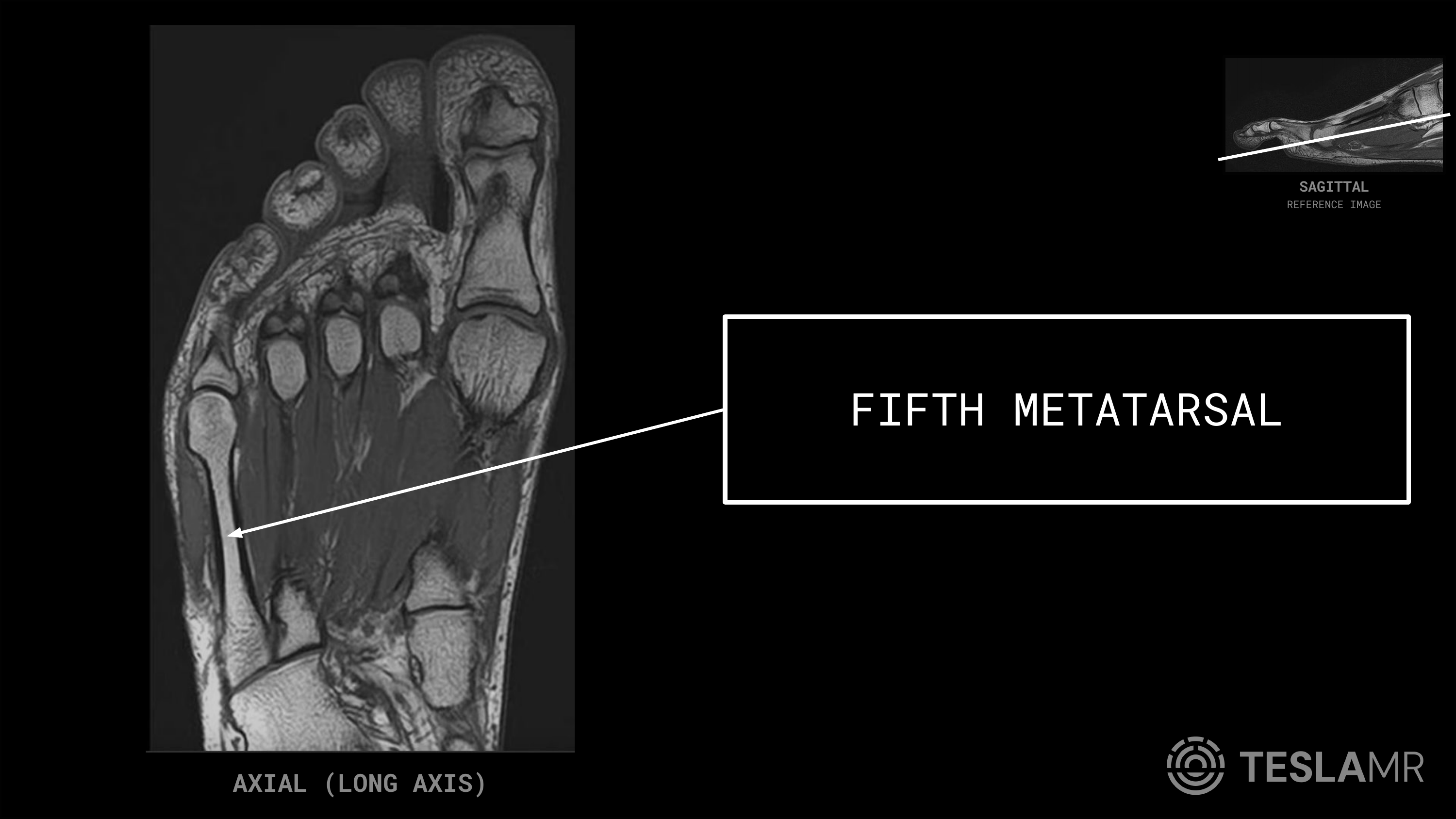 Fifth Metatarsal labeled on a Foot MRI (Axial · Coronal)