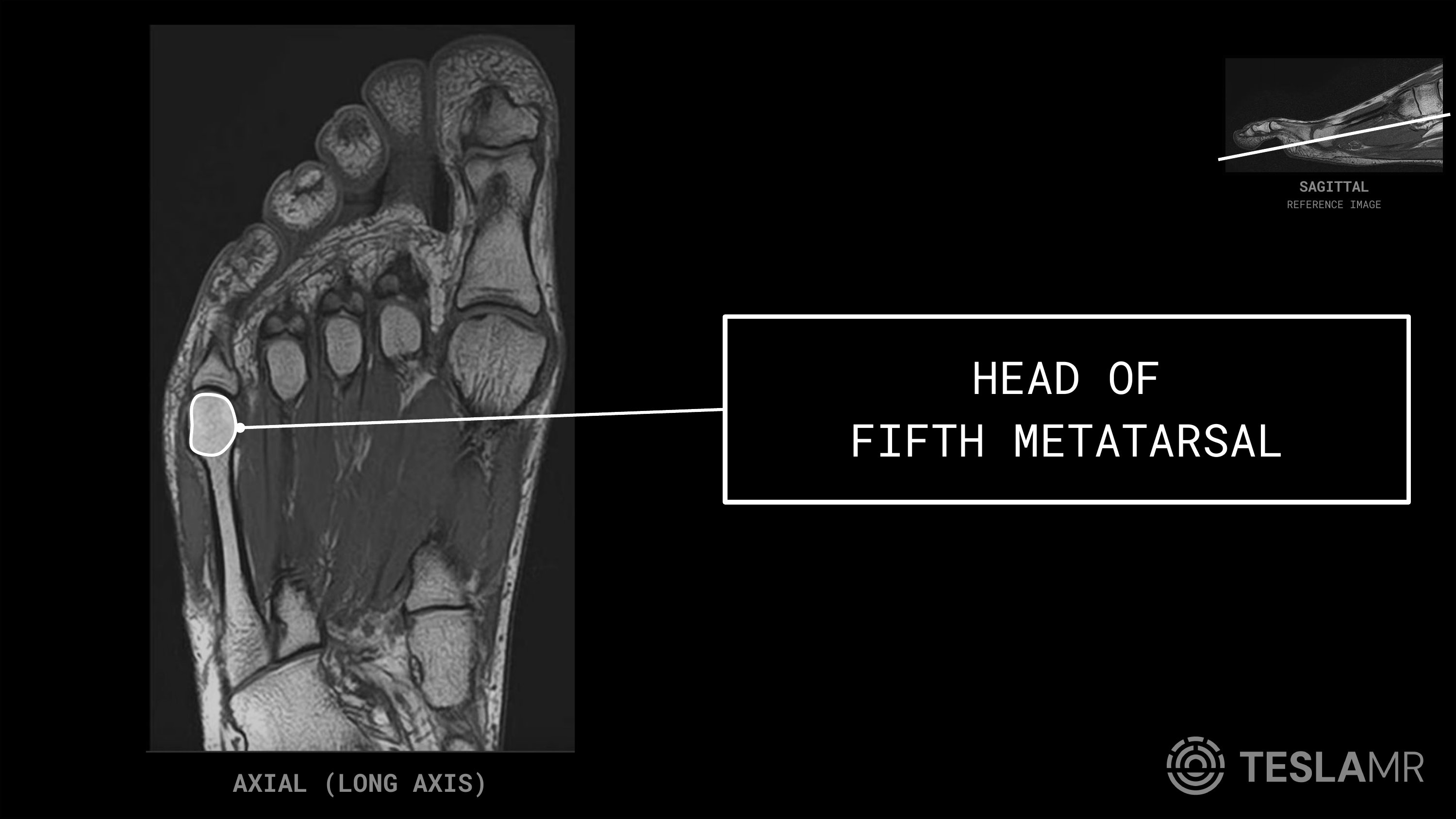 Head of Fifth Metatarsal labeled on a Foot MRI (Axial)