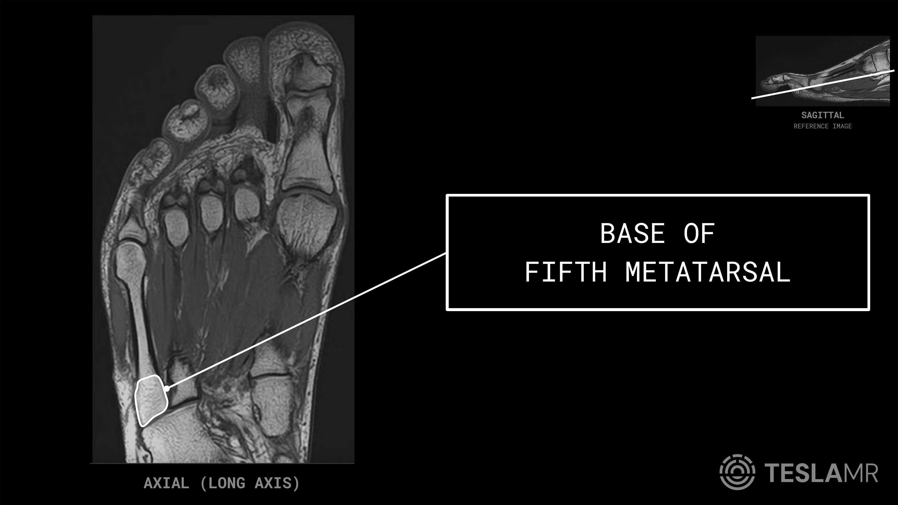 Base of Fifth Metatarsal labeled on a Foot MRI (Axial)