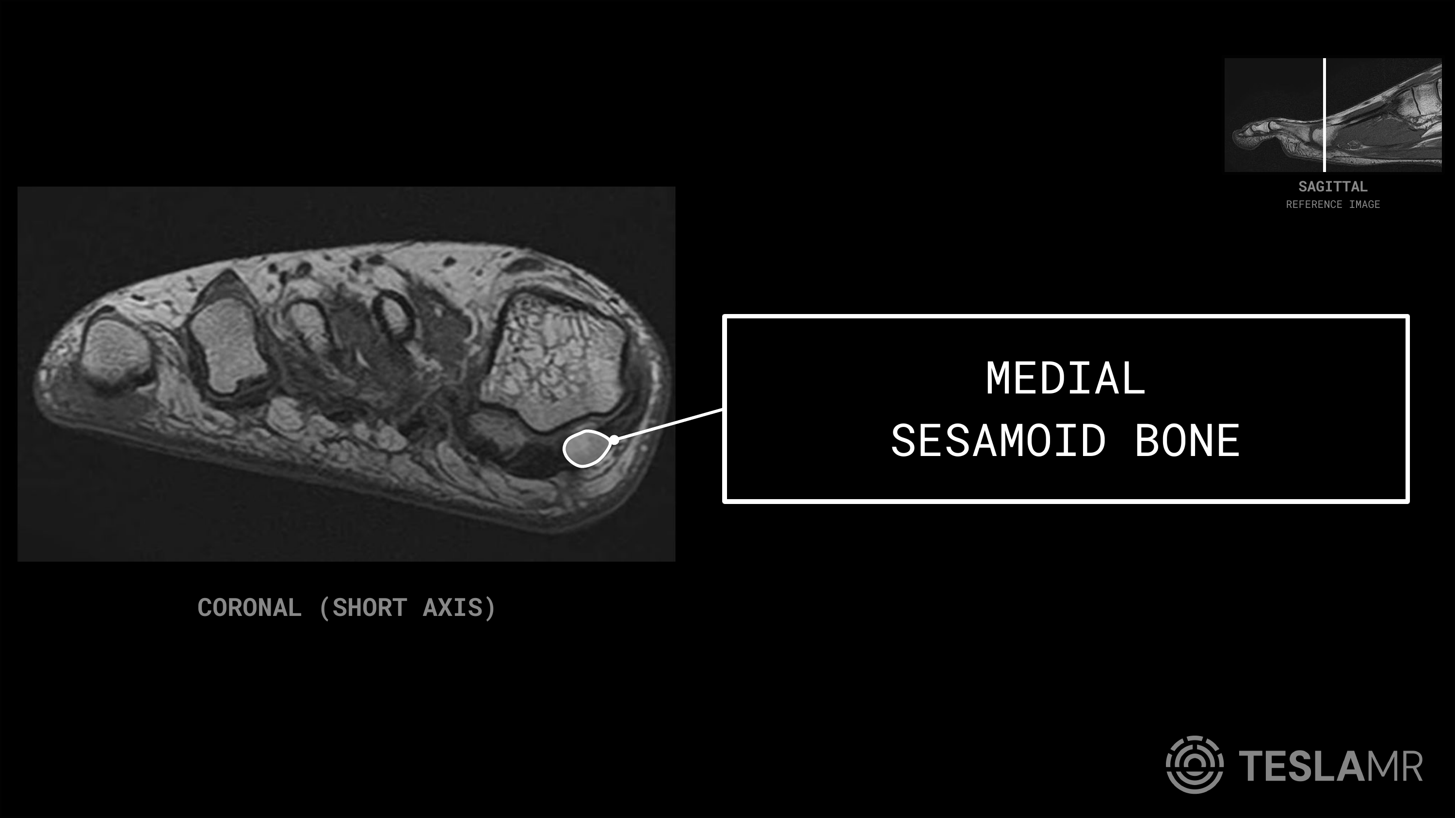 Medial Sesamoid Bone labeled on a Foot MRI (Coronal)