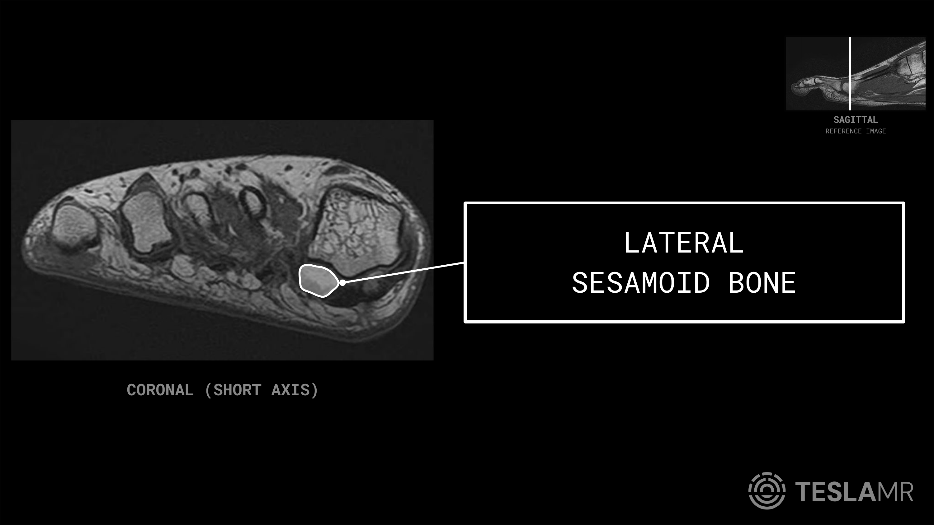 Lateral Sesamoid Bone labeled on a Foot MRI (Coronal)