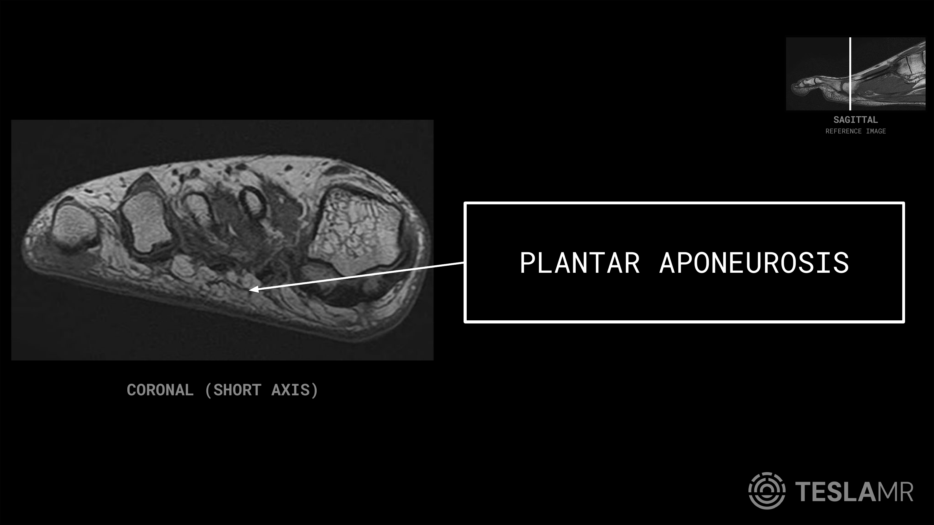 Plantar Aponeurosis labeled on a Foot MRI (Coronal)