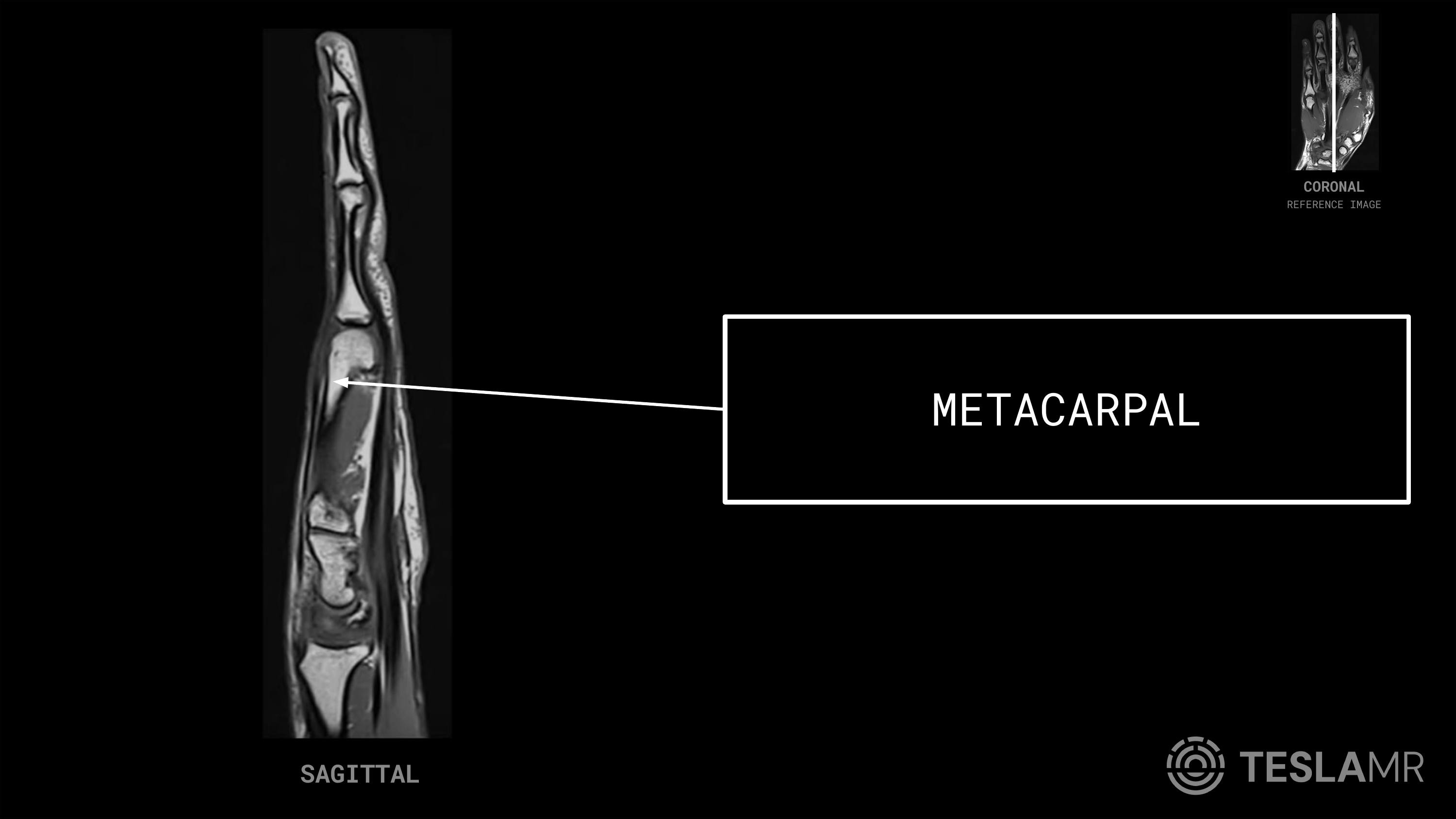 Metacarpal labeled on a Hand MRI (Sagittal)