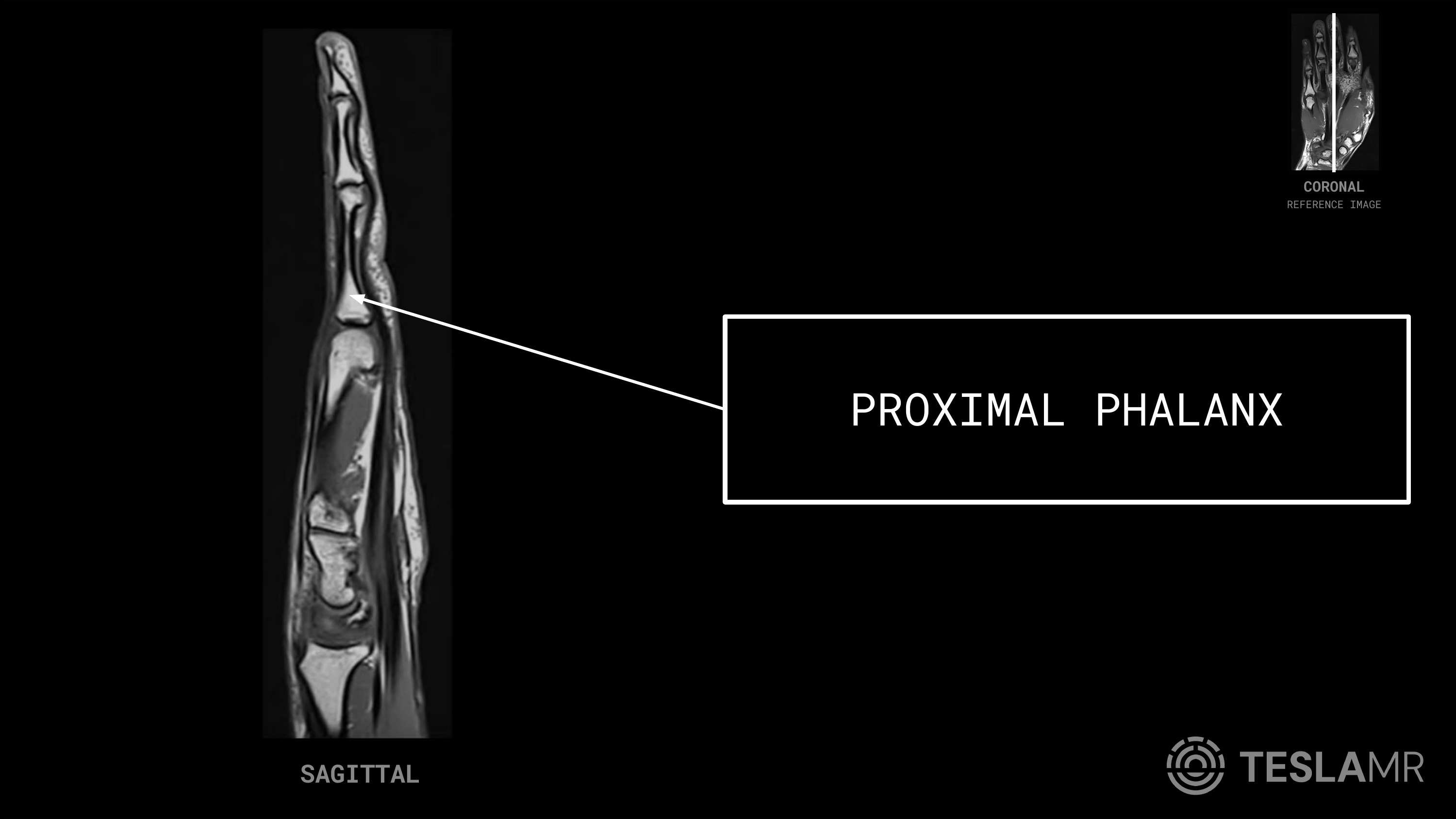 Proximal Phalanx labeled on a Hand MRI (Sagittal)