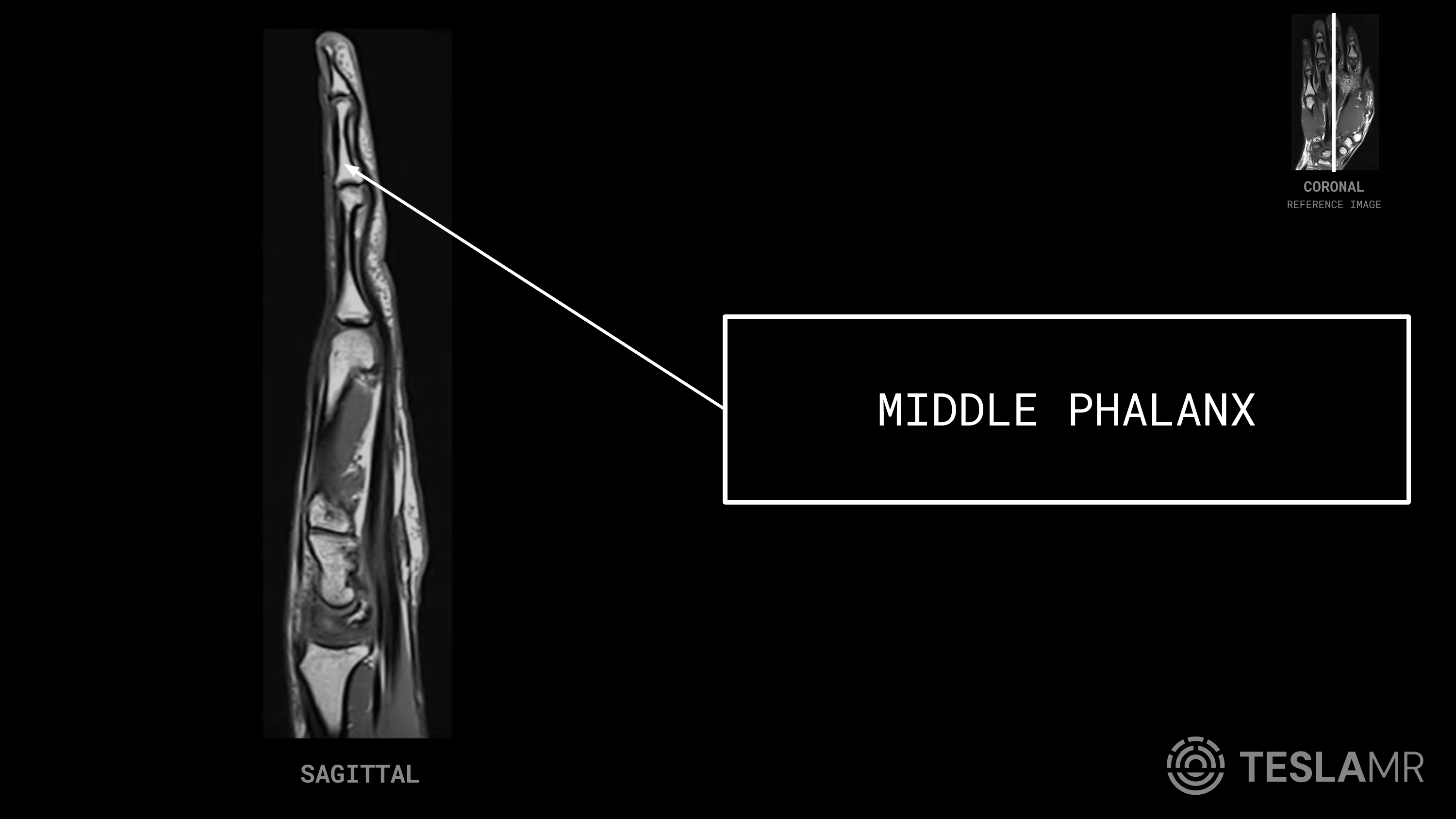 Middle Phalanx labeled on a Hand MRI (Sagittal)
