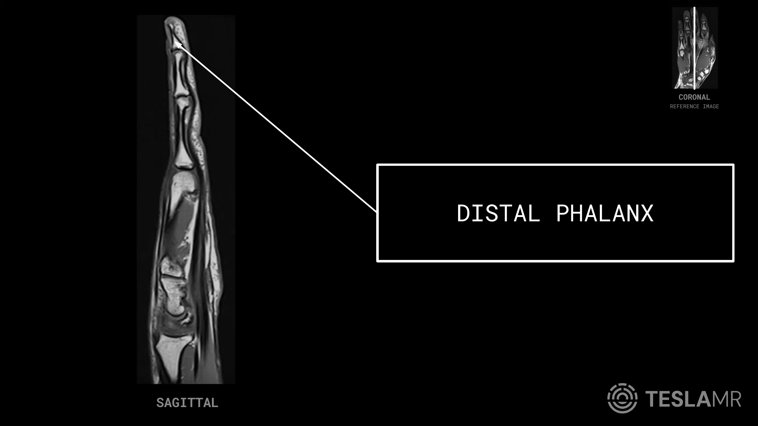 Distal Phalanx labeled on a Hand MRI (Sagittal)