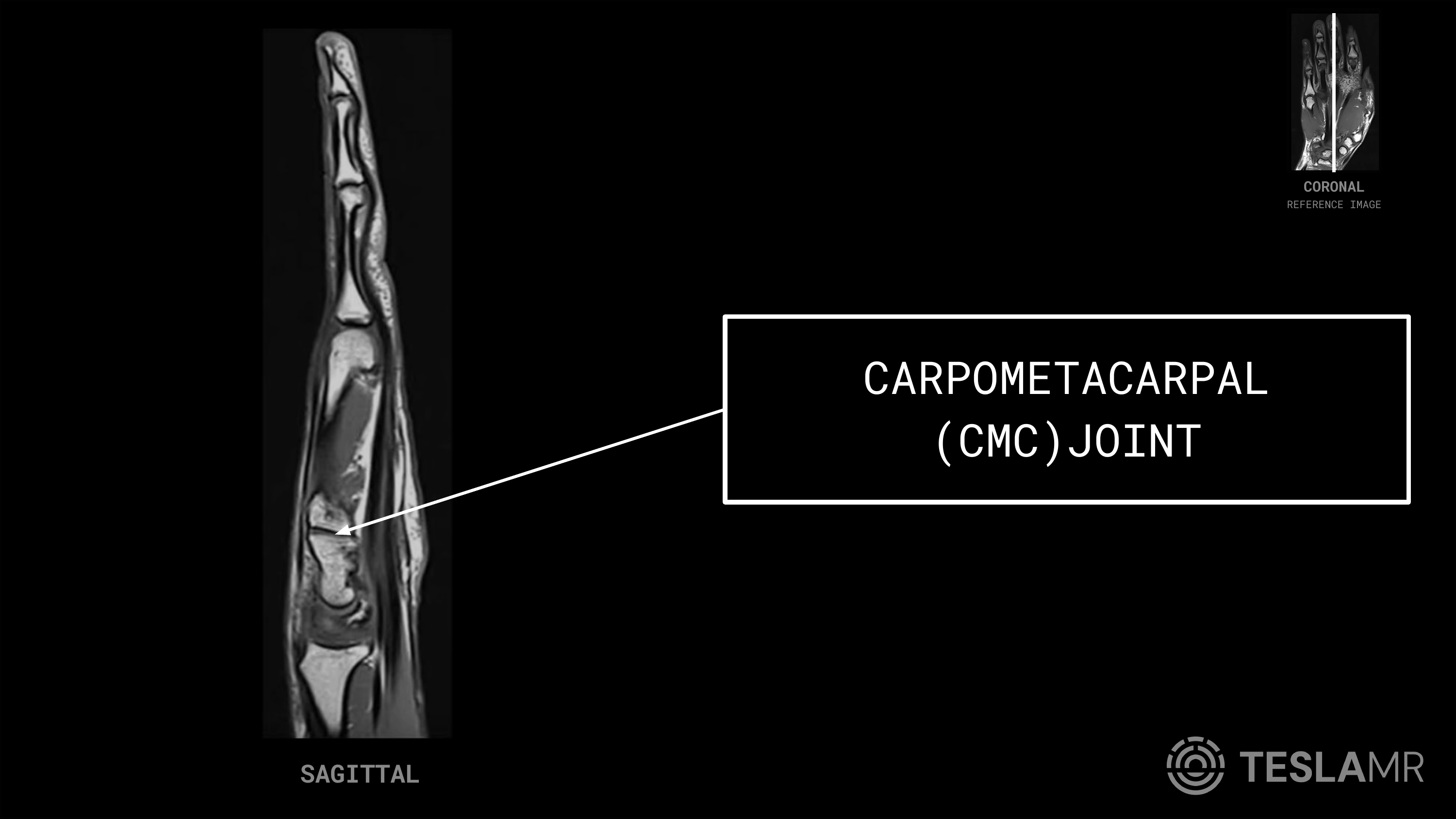 Carpometacarpal (CMC) Joint labeled on a Hand MRI (Sagittal)