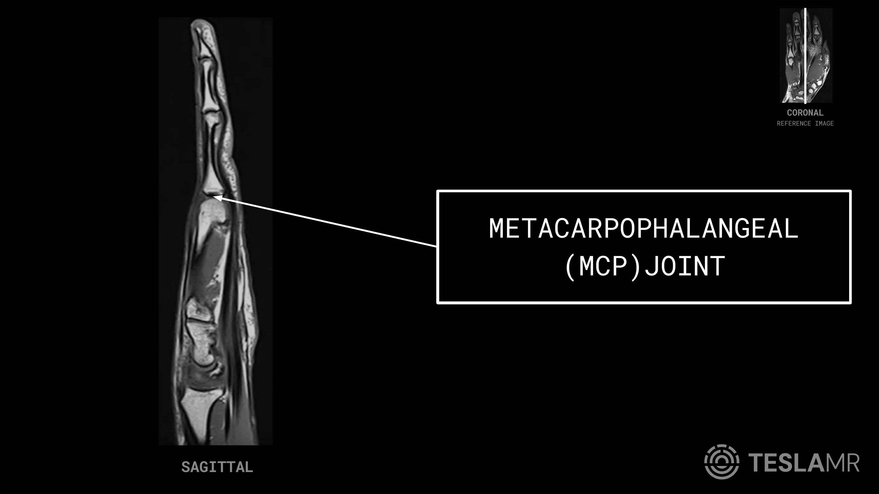 Metacarpophalangeal (MCP) Joint labeled on a Hand MRI (Sagittal)