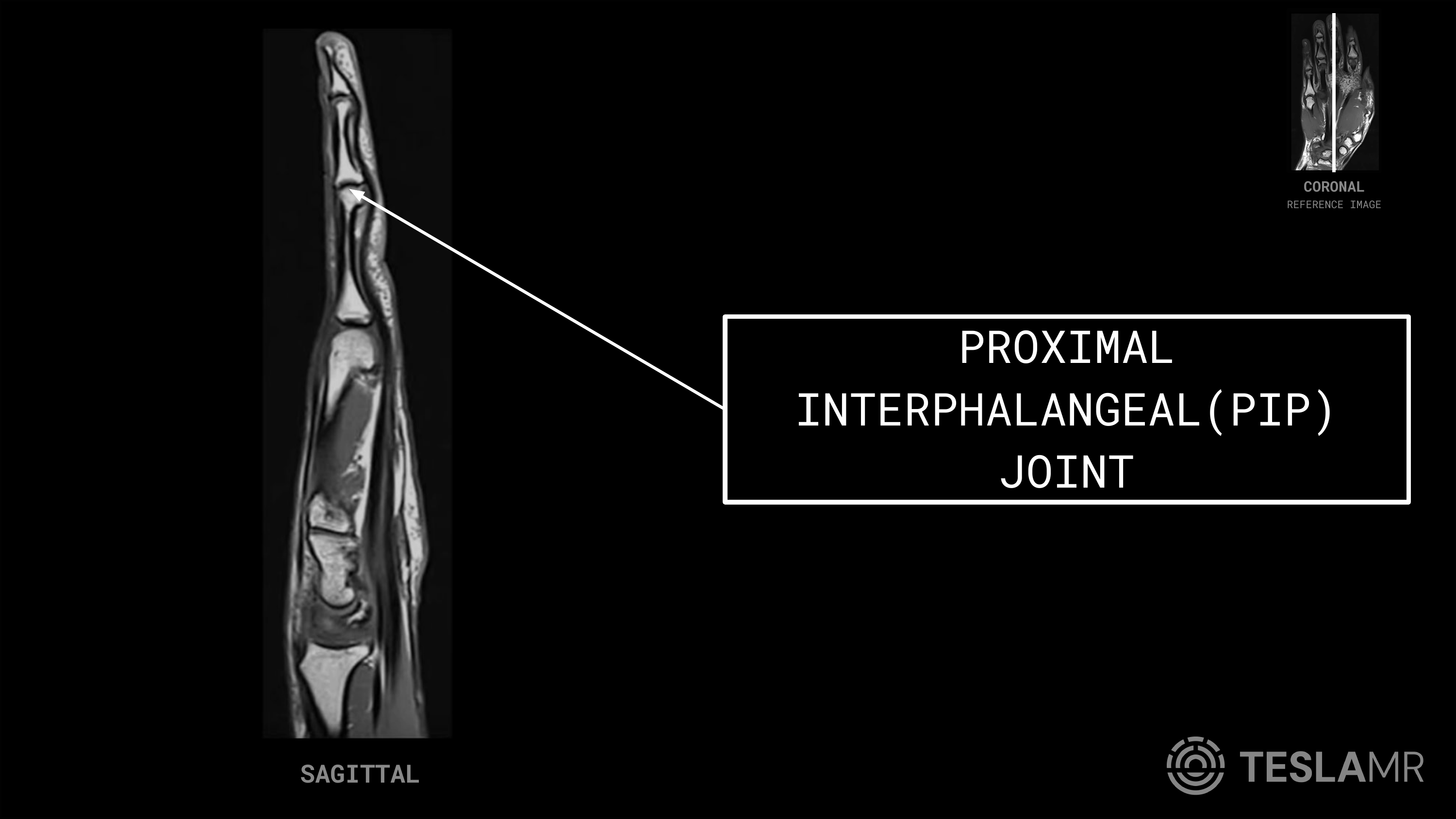 Proximal Interphalangeal (PIP) Joint labeled on a Hand MRI (Sagittal)