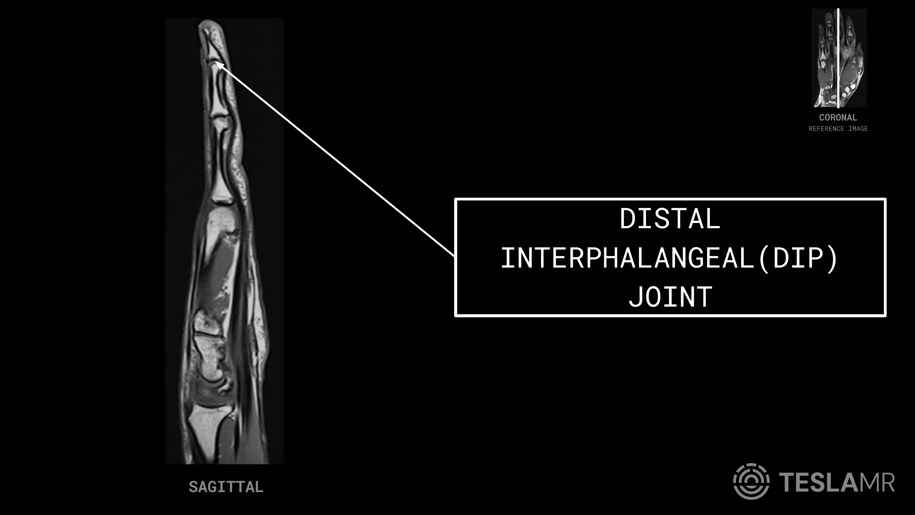 Distal Interphalangeal (DIP) Joint labeled on a Hand MRI (Sagittal)