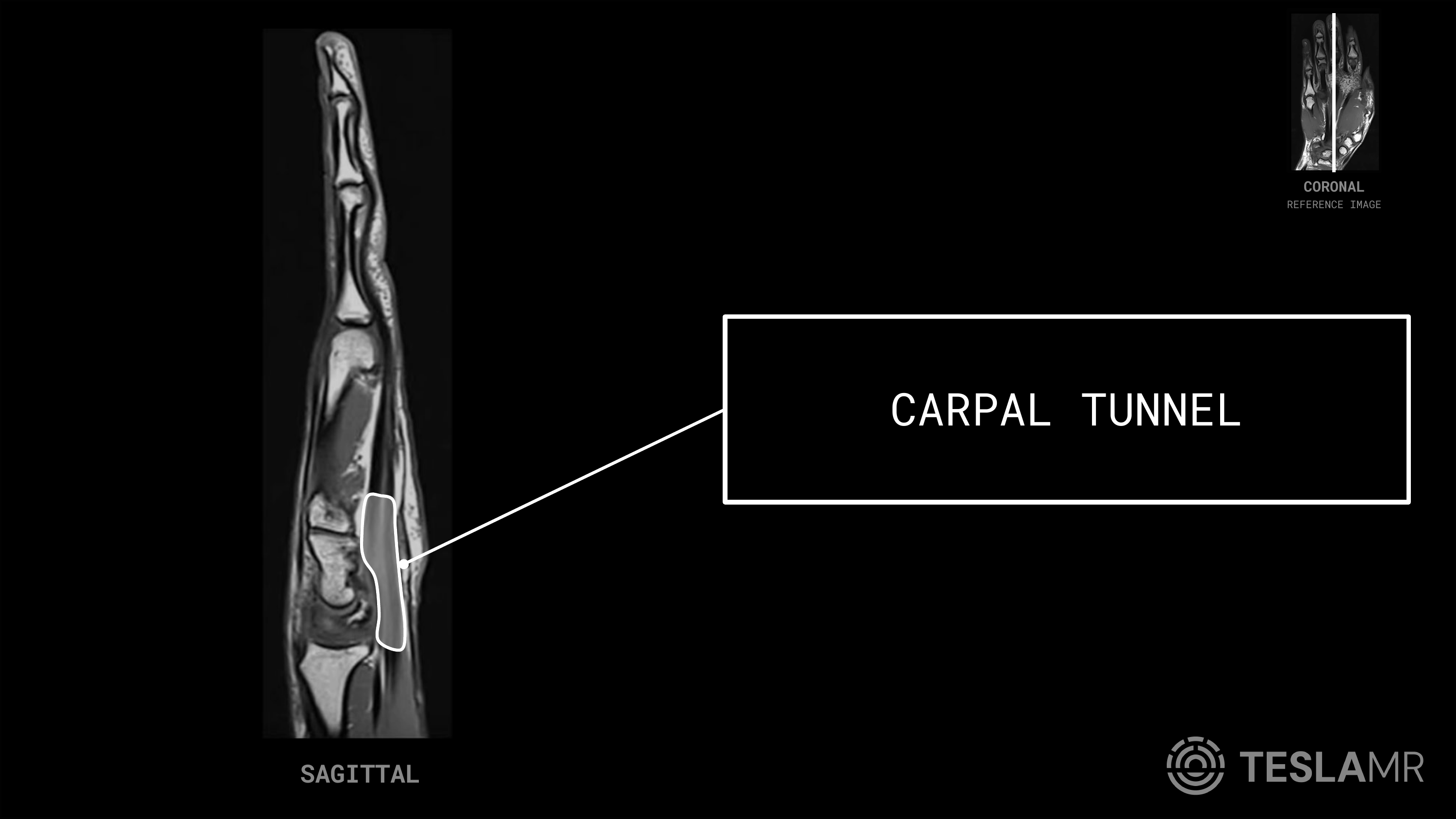 Carpal Tunnel labeled on a Hand MRI (Sagittal)