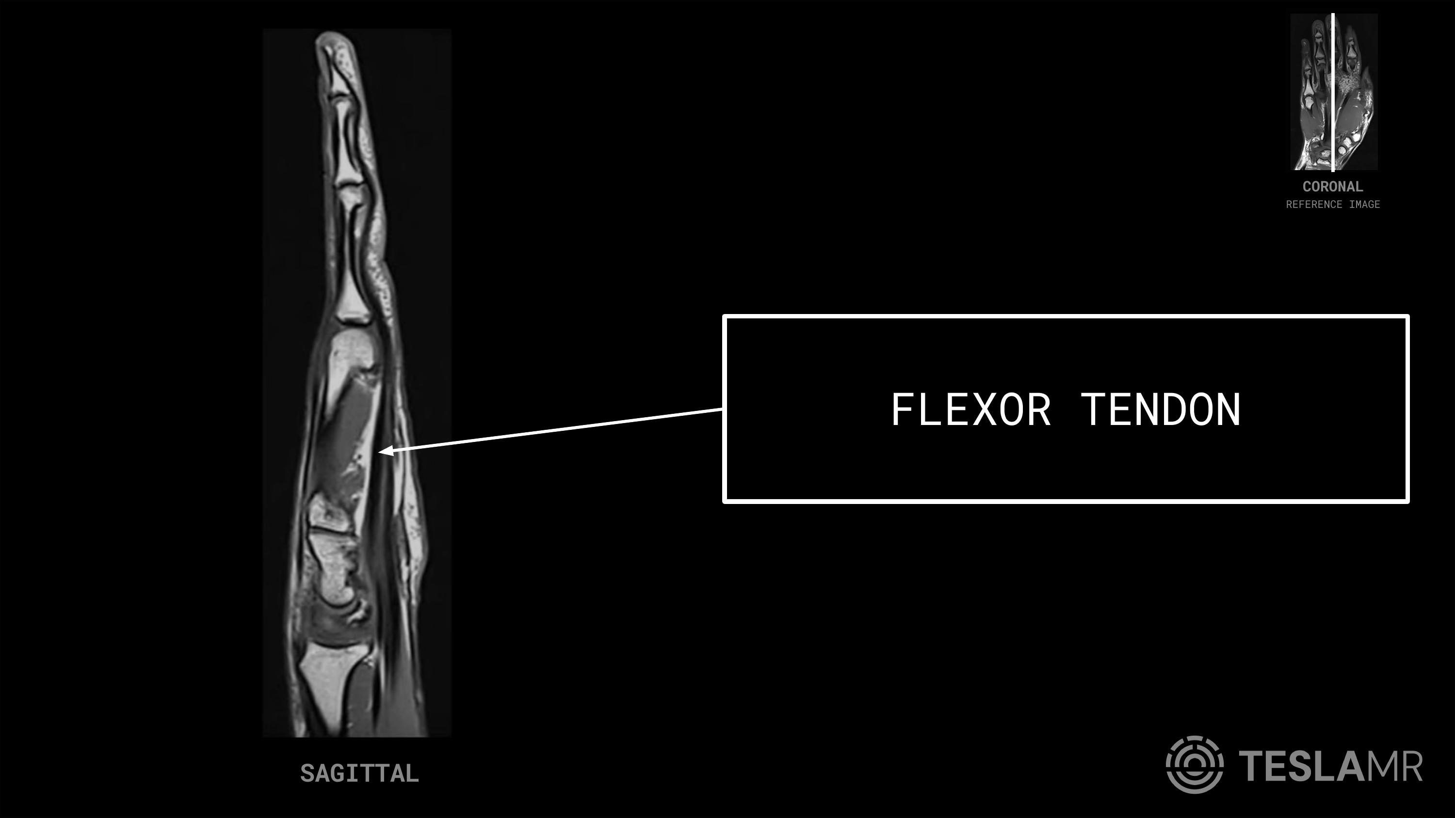 Flexor Tendon labeled on a Hand MRI (Sagittal)