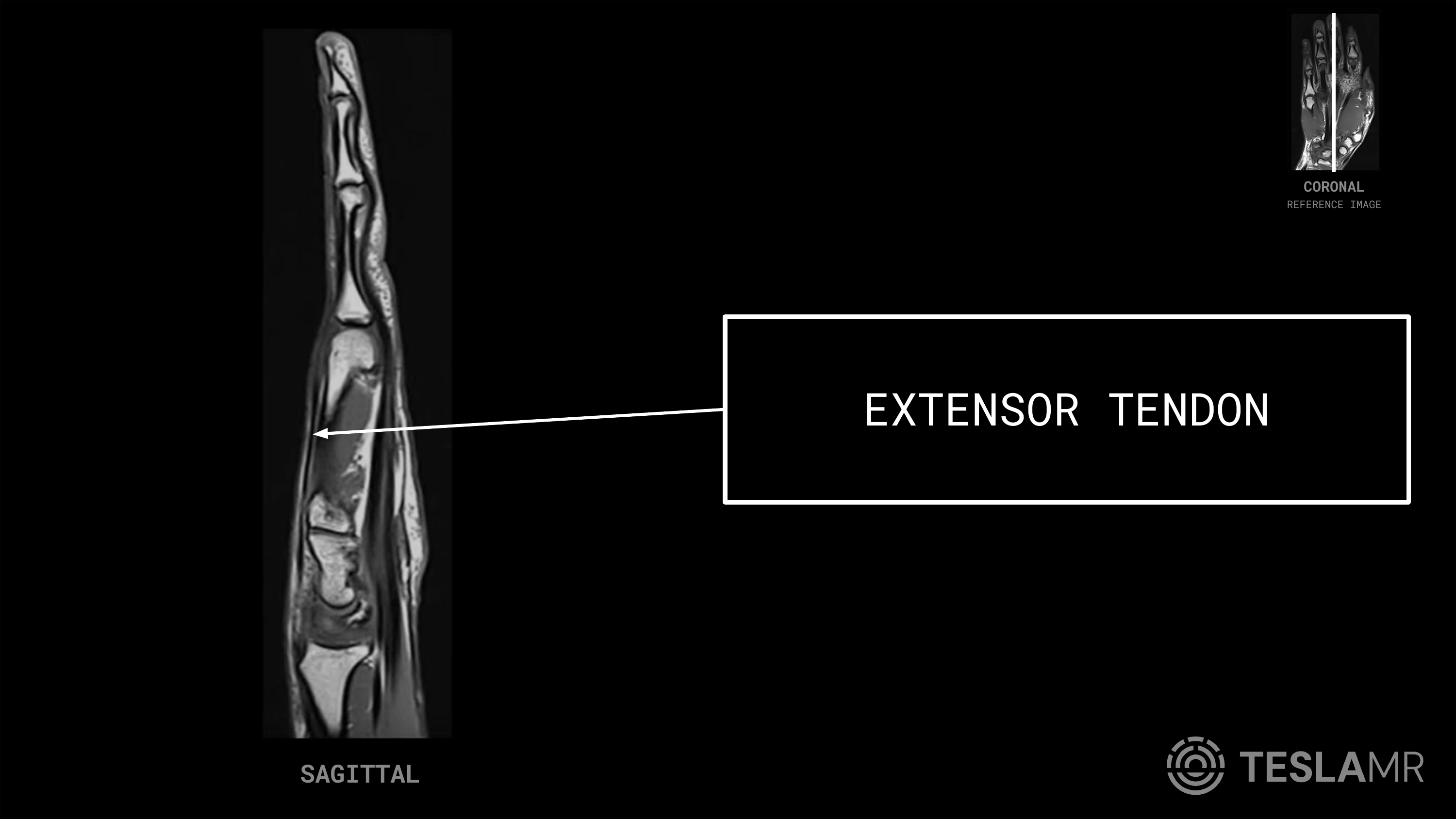 Extensor Tendon labeled on a Hand MRI (Sagittal)