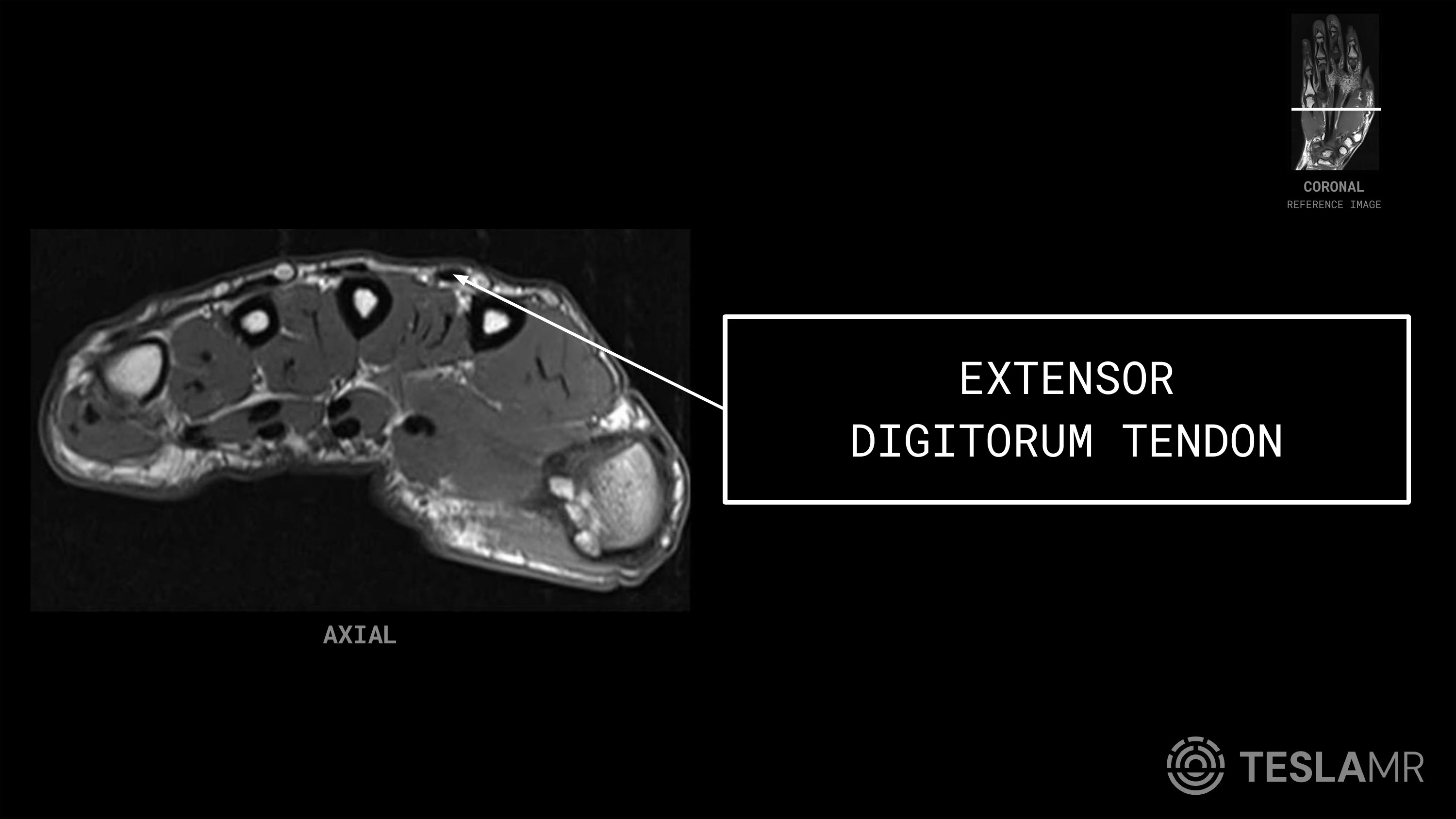 Extensor Digitorum Tendon labeled on a Hand MRI (Axial)