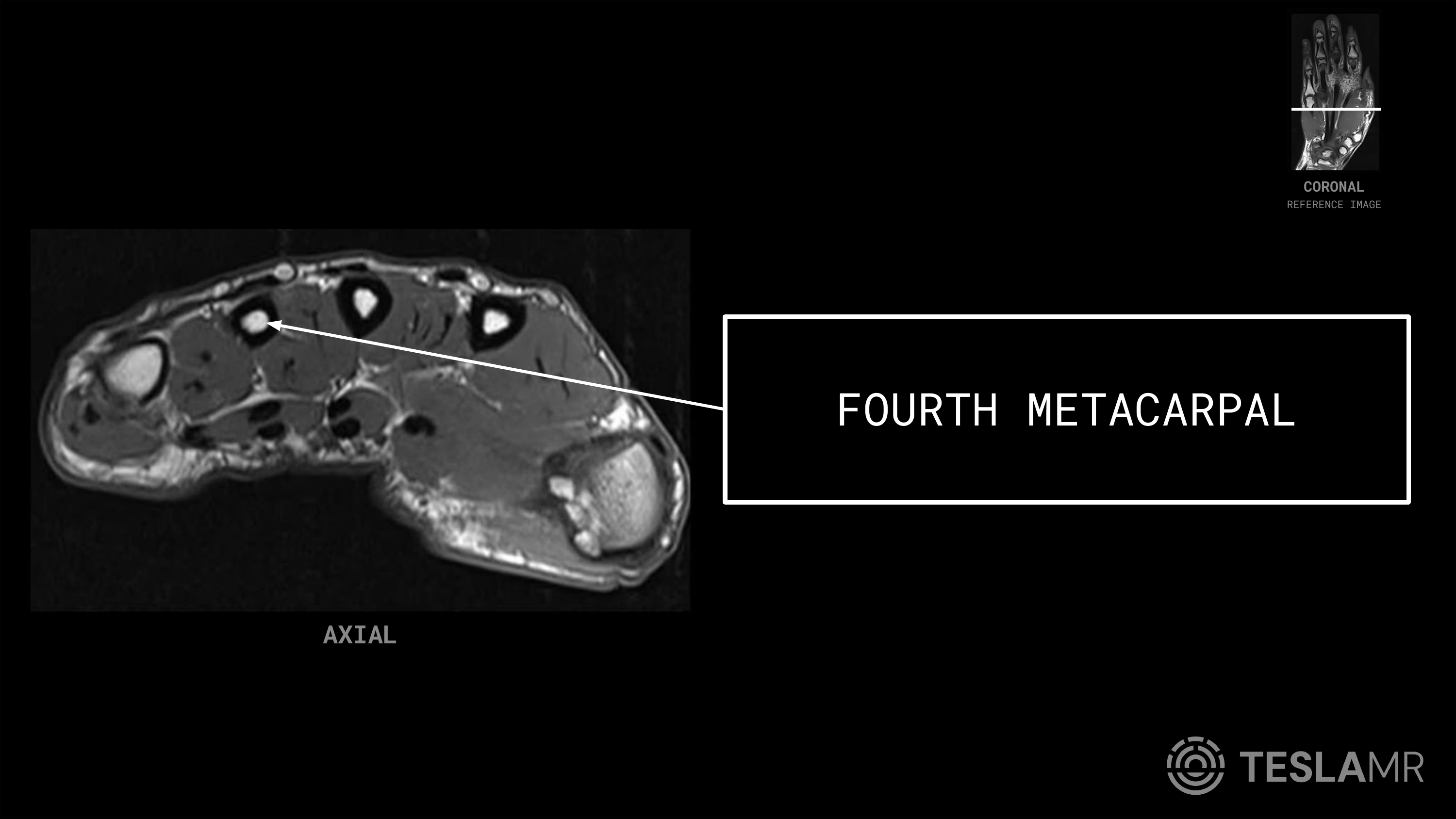 Fourth Metacarpal labeled on a Hand MRI (Axial)