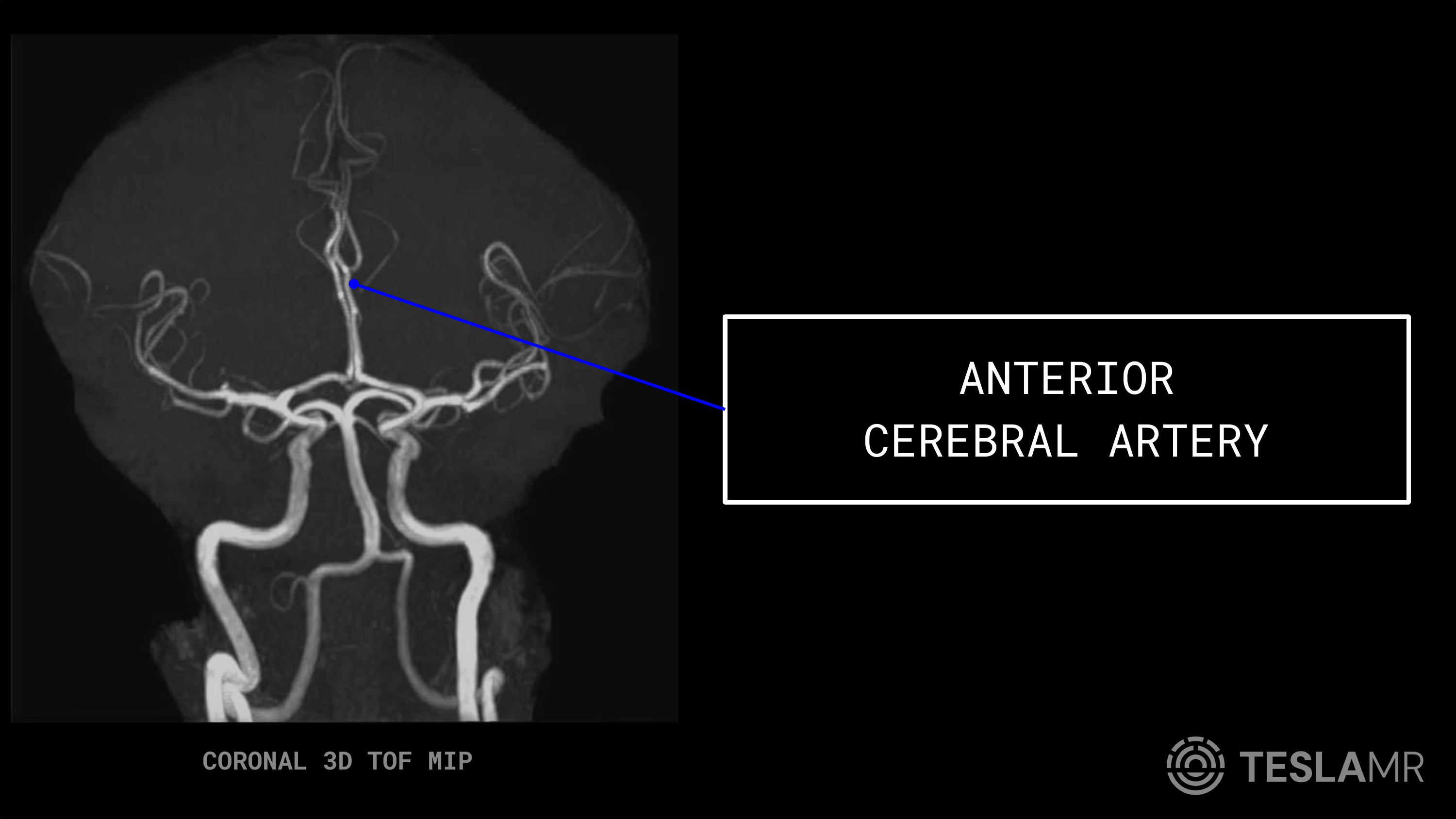 Anterior Cerebral Artery labeled on a Head / COW MRI (Coronal · Sagittal)