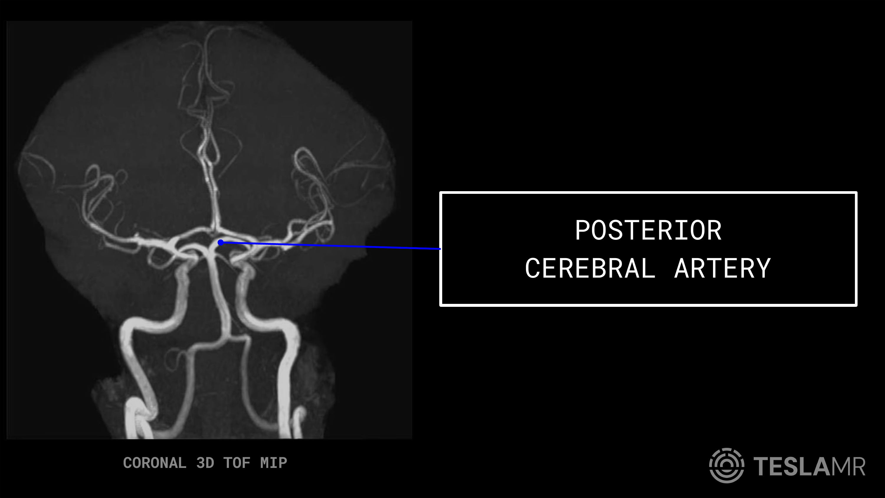 Posterior Cerebral Artery labeled on a Head / COW MRI (Coronal · Sagittal)