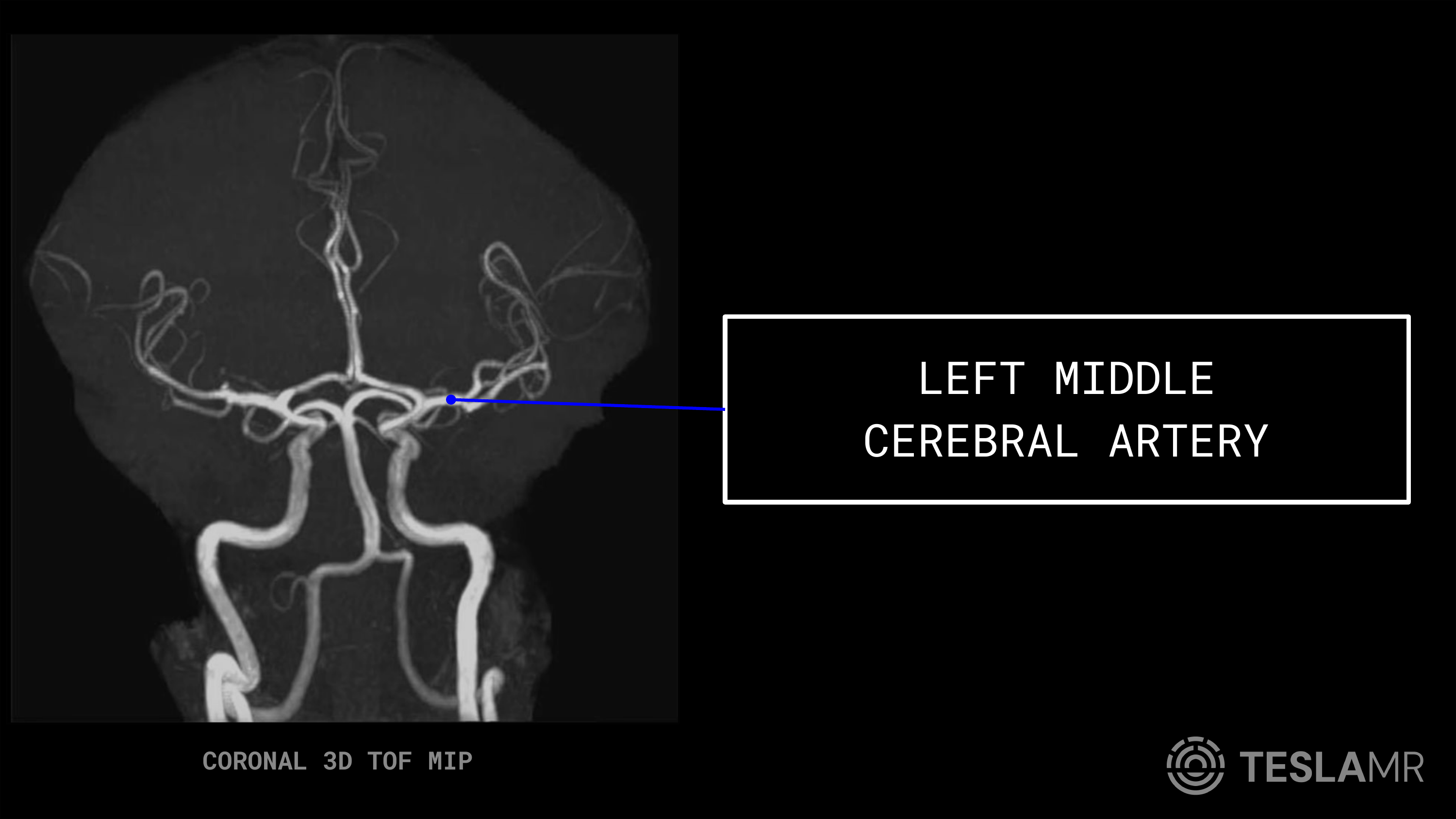 Left Middle Cerebral Artery labeled on a Head / COW MRI (Coronal)
