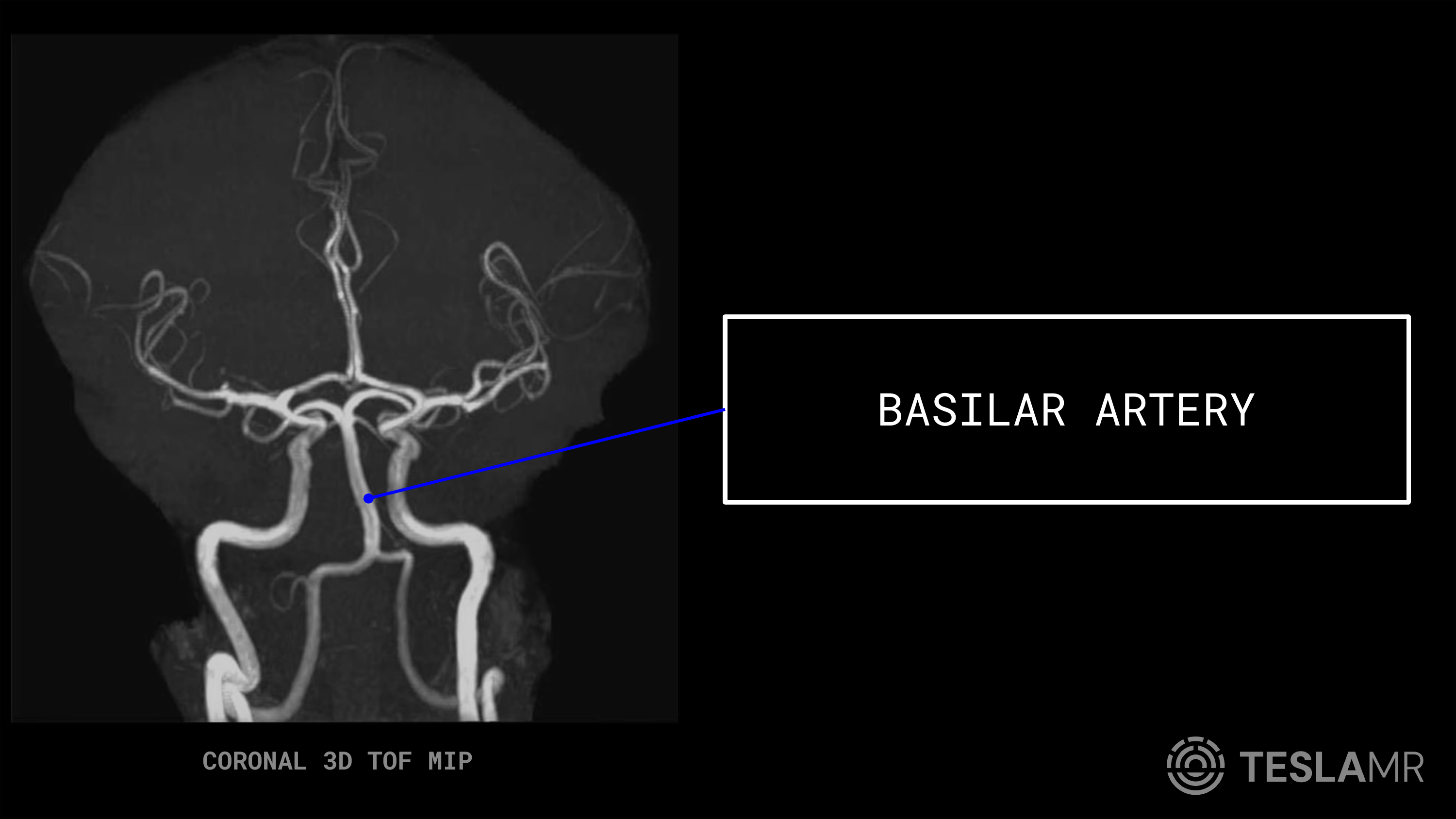 Basilar Artery labeled on a Head / COW MRI (Coronal · Sagittal)
