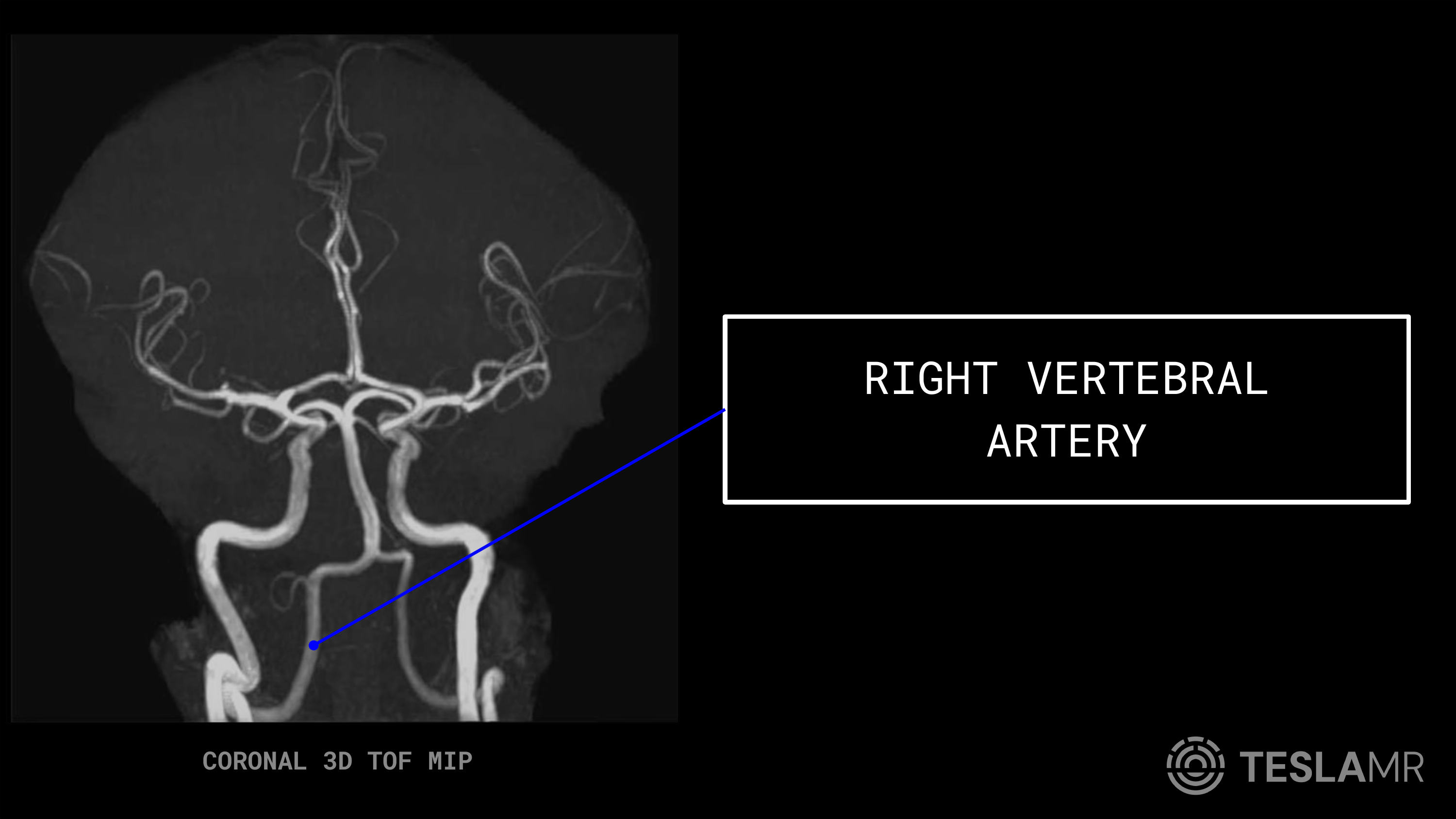Right Vertebral Artery labeled on a Head / COW MRI (Coronal)