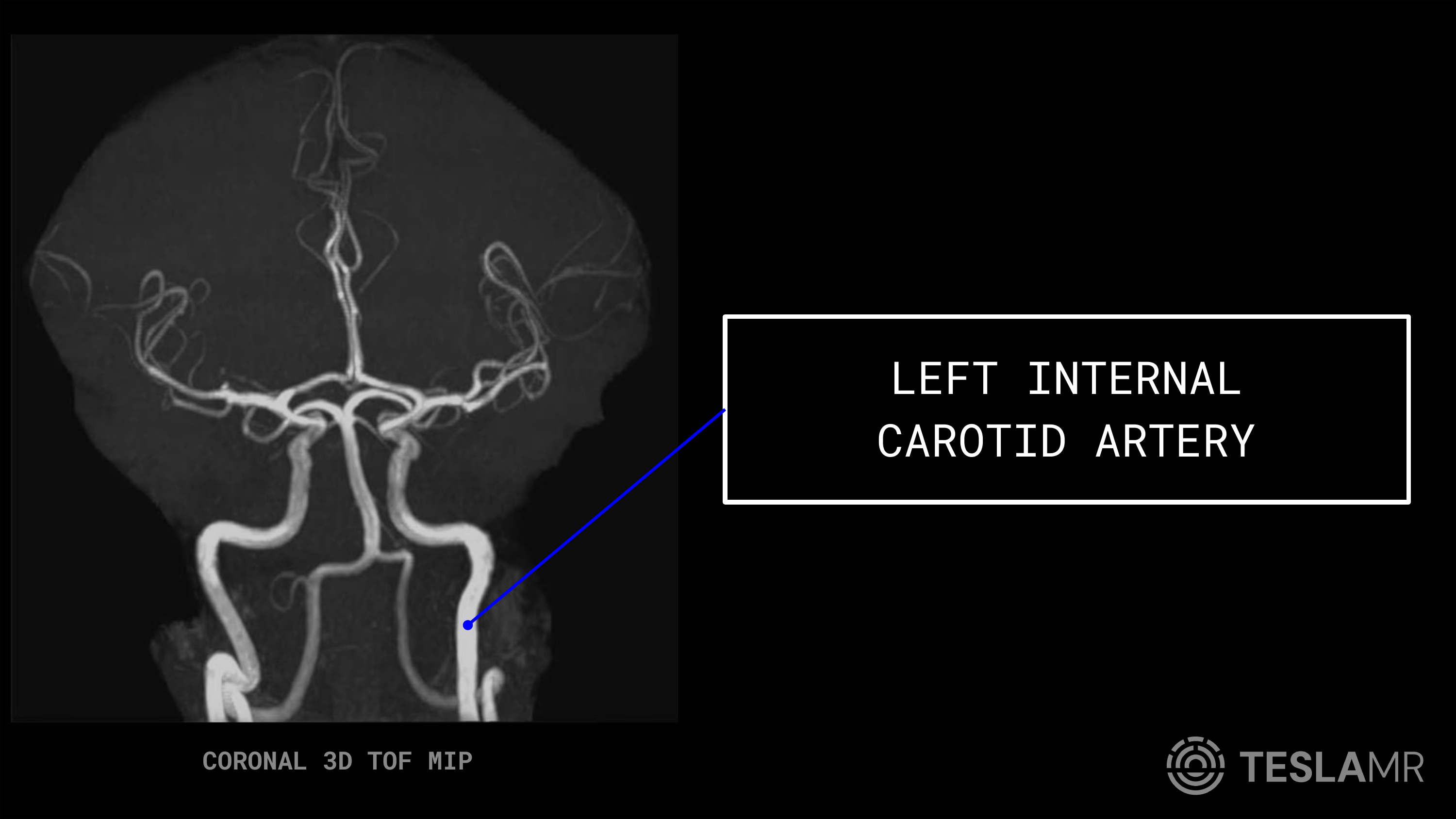 Left Internal Carotid Artery labeled on a Head / COW MRI (Coronal)