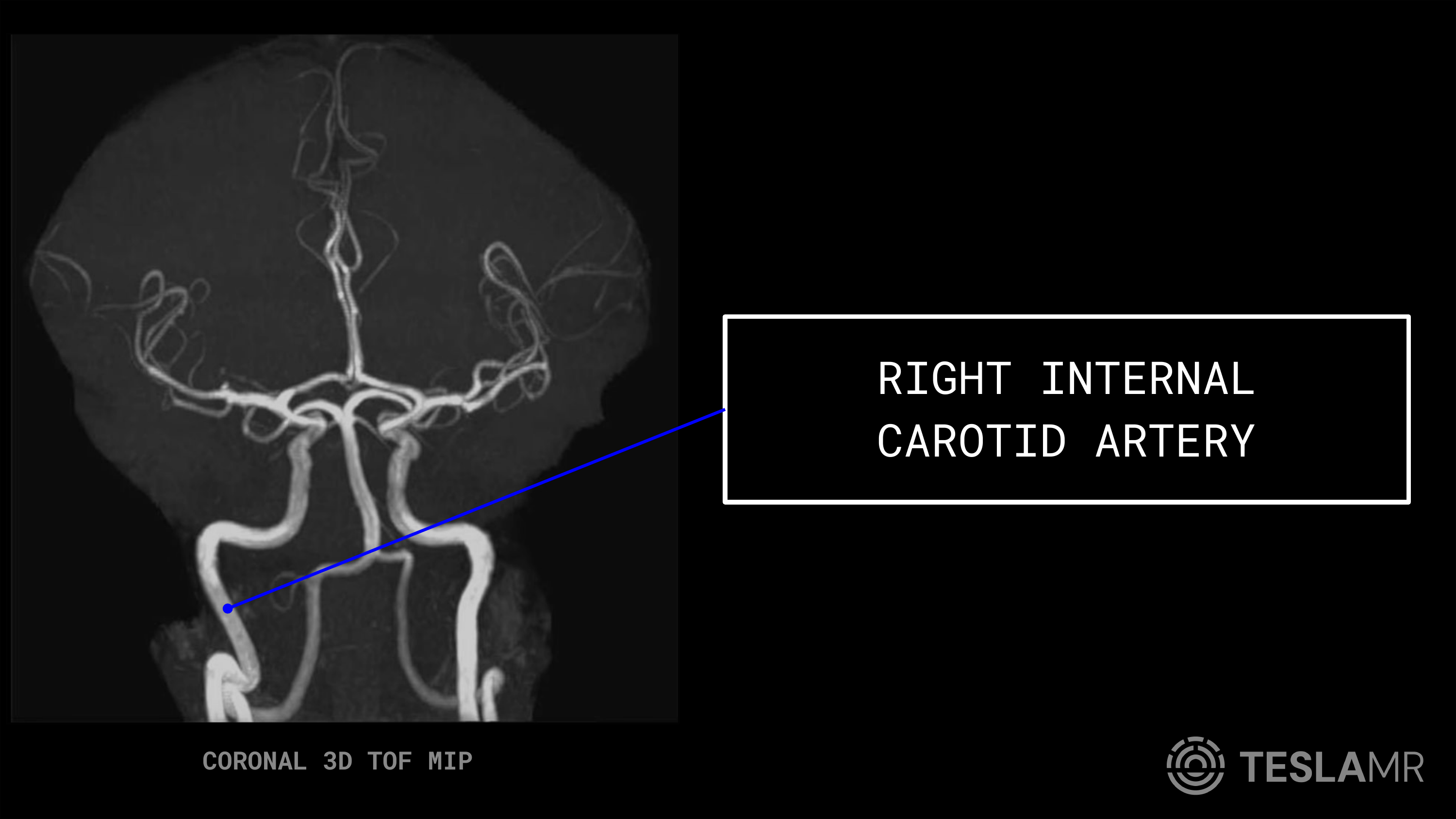Right Internal Carotid Artery labeled on a Head / COW MRI (Coronal)